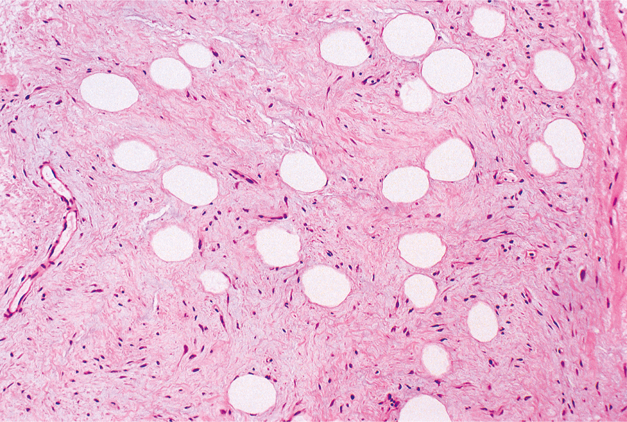 A microscopic view of fibrous tissue containing multiple round to oval empty spaces surrounded by spindle-shaped cells and scattered elongated nuclei.