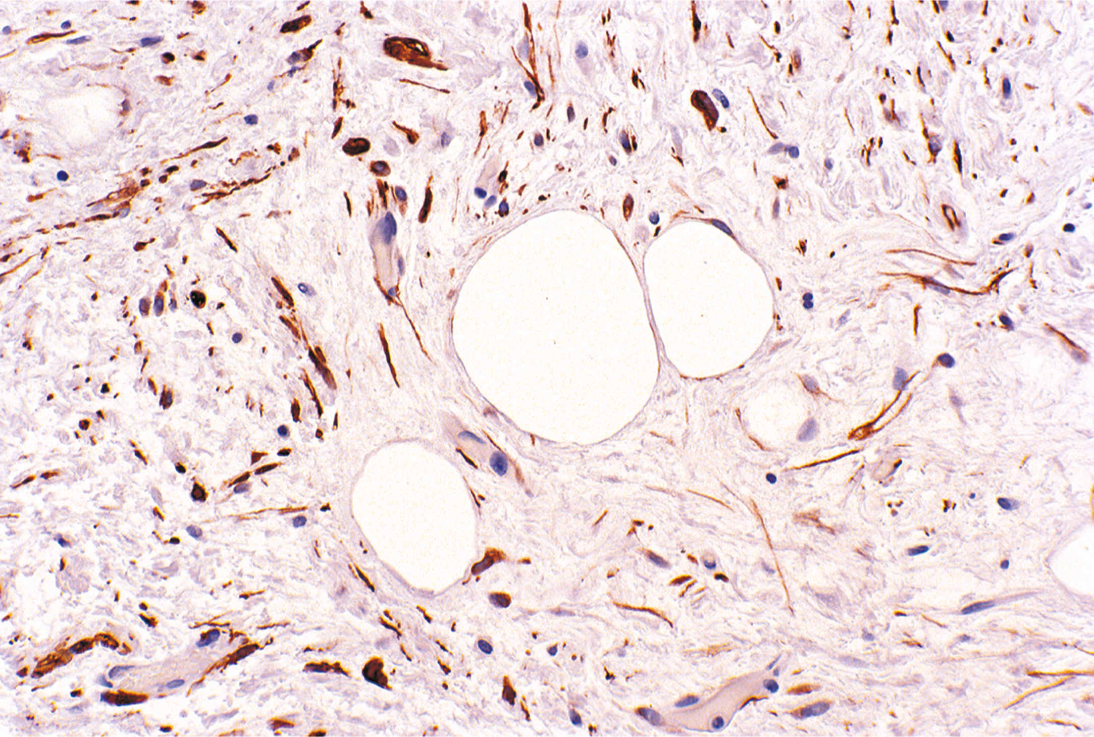A microscopic view of fibrous tissue with scattered spindle-shaped cells and multiple large, round, empty spaces.