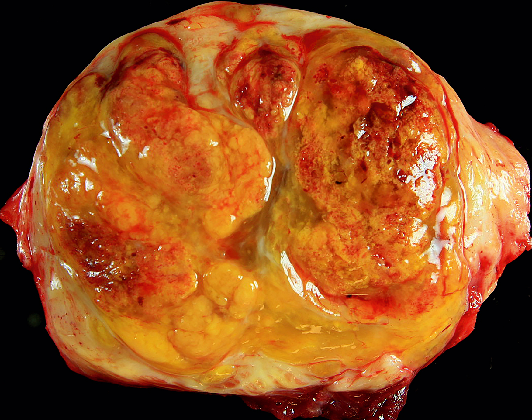 A gross specimen of a well-circumscribed, multilobulated mass with a glistening surface and a yellowish nodular internal structure.