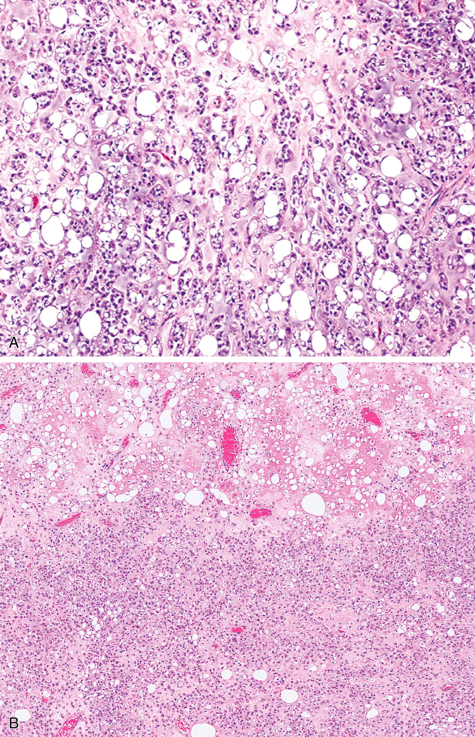 A set of two microscopic views labeled A and B displays chondroid lipoma with numerous vacuolated cells with a dense cellular infiltrate throughout the field. The set of two microscopic views labeled A and B displays chondroid lipoma. Part A displays a histological section with numerous vacuolated cells interspersed among densely packed small round cells with distinct nuclei. The cellular arrangement appears irregular, with some areas of infiltration. Part B displays a broader view with abundant vacuolated spaces in the upper field and a dense population of small round cells in the lower portion. Several blood vessels are present throughout the section. Both sections reveal a heterogeneous pattern with variation in cellular density, vacuolated areas, and structural organization, indicating complex tissue architecture across the samples.