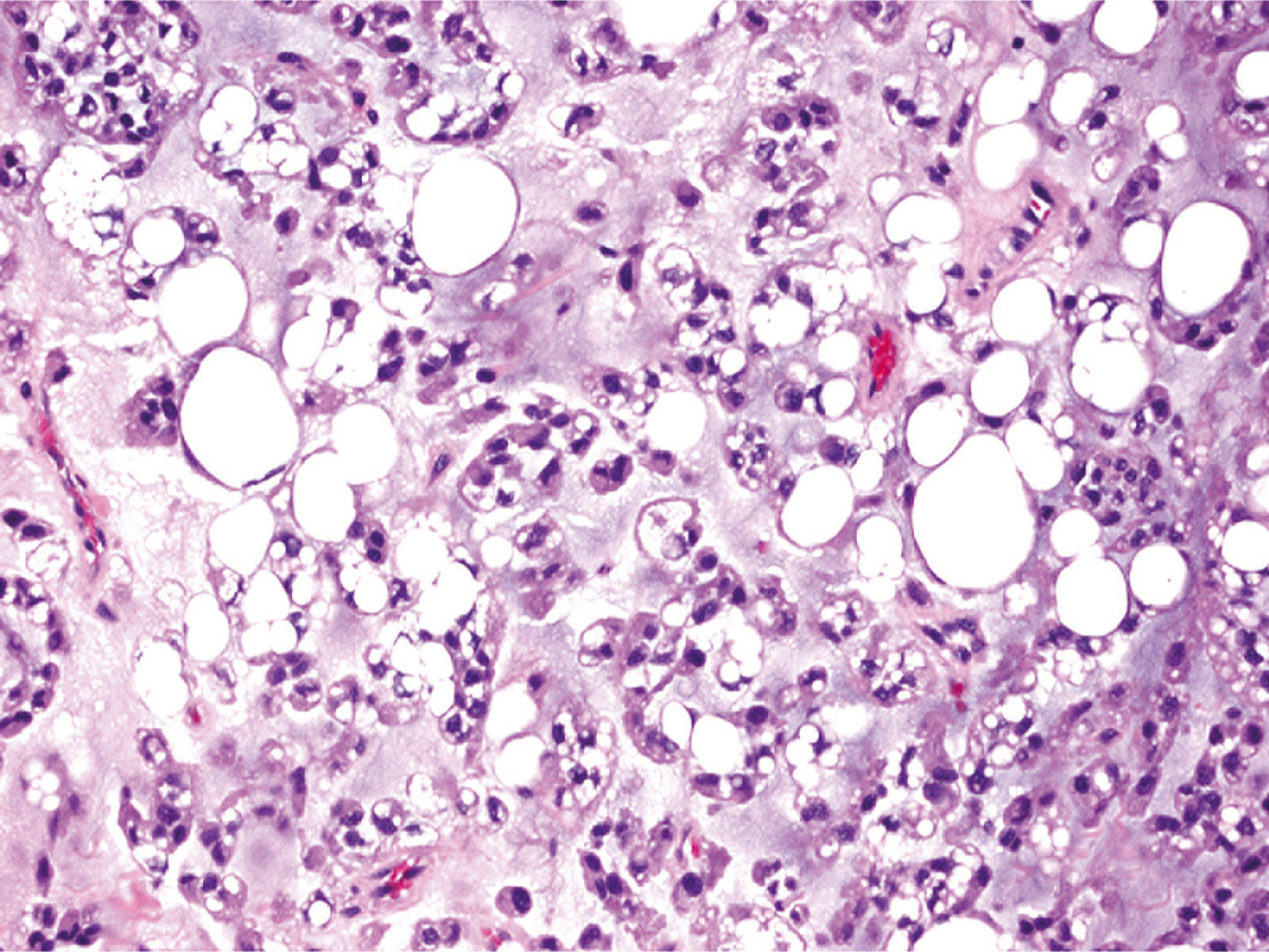 A microscopic view of numerous round vacuoles and clusters of densely packed cells interspersed throughout a granular extracellular matrix showing chondroid lipoma. The microscopic view presents a high-magnification view of tissue with numerous circular vacuolated structures distributed throughout the field. The vacuoles vary in size and appear interspersed within a background of densely packed cells containing distinct nuclei. The cells exhibit a granular cytoplasm and form irregular groupings. The extracellular matrix appears slightly disrupted, with areas of loose structure separating the cellular clusters. Some blood vessels are visible, and the tissue organization lacks a uniform pattern, indicating variation in cellular distribution and structure.