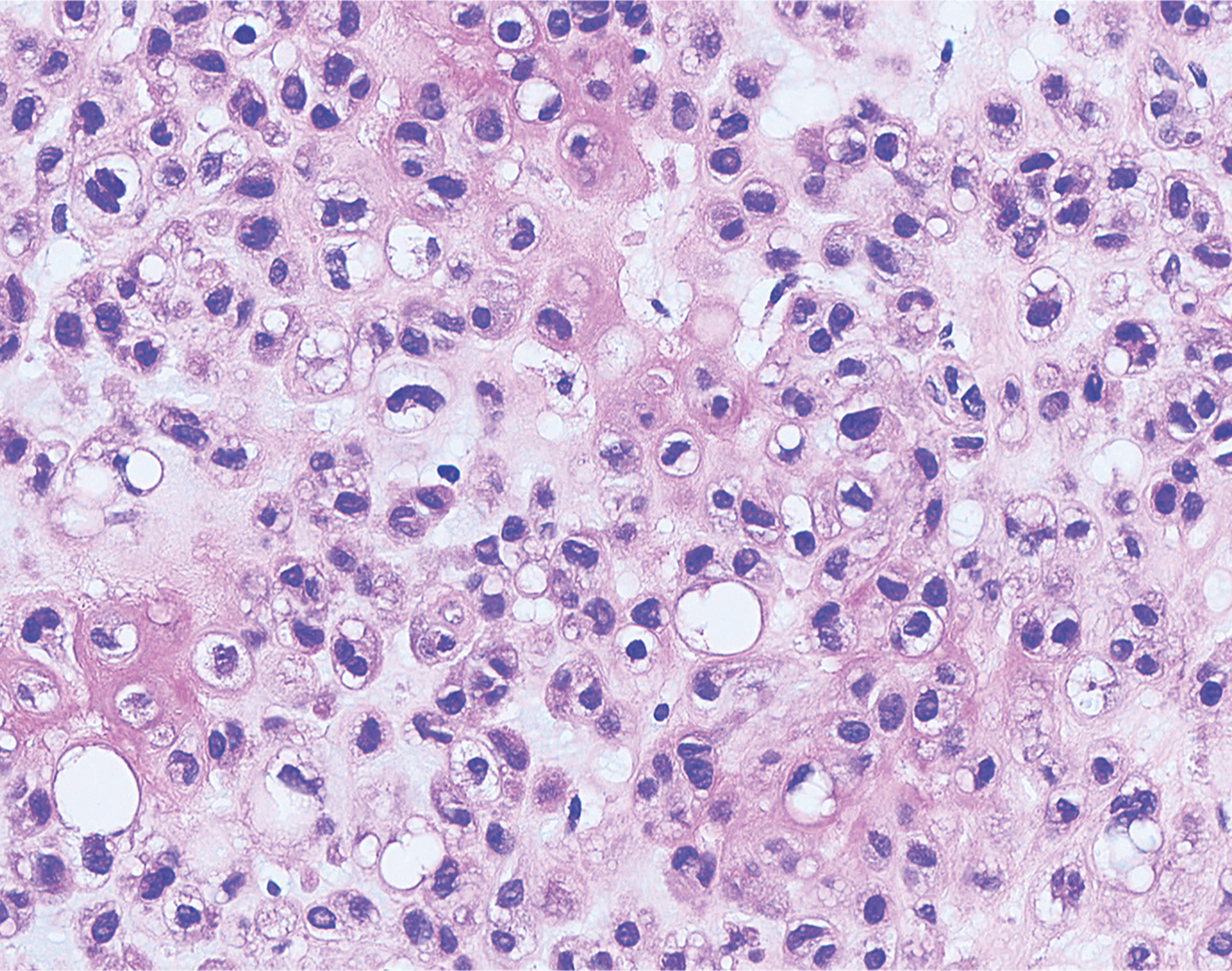 A microscopic view of numerous round cells, vacuoles, and irregular nuclei scattered within a granular tissue shows cytologic atypia in chondroid lipoma. The microscopic view displays numerous round to oval cells dispersed throughout the tissue. Many cells contain prominent irregular nuclei and cytoplasmic vacuoles. The cells vary in size and shape and are embedded in a granular matrix with inconsistent distribution. Some vacuoles appear empty, while others are surrounded by compressed cytoplasm. The nuclei are dense and dark-staining, and some show displacement due to adjacent vacuoles. There is no clear tissue architecture, and cellular arrangement appears disordered throughout the field.