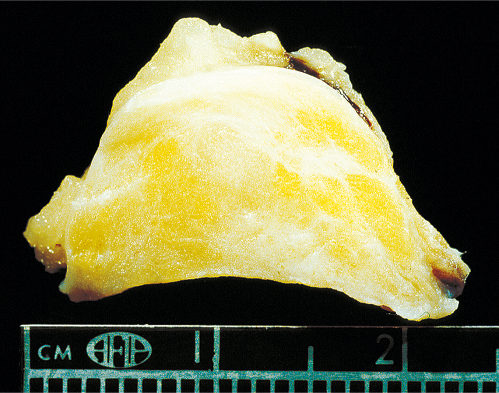 A gross tissue specimen with a thick yellow layer and an overlying pale translucent cap is placed above a measurement scale.