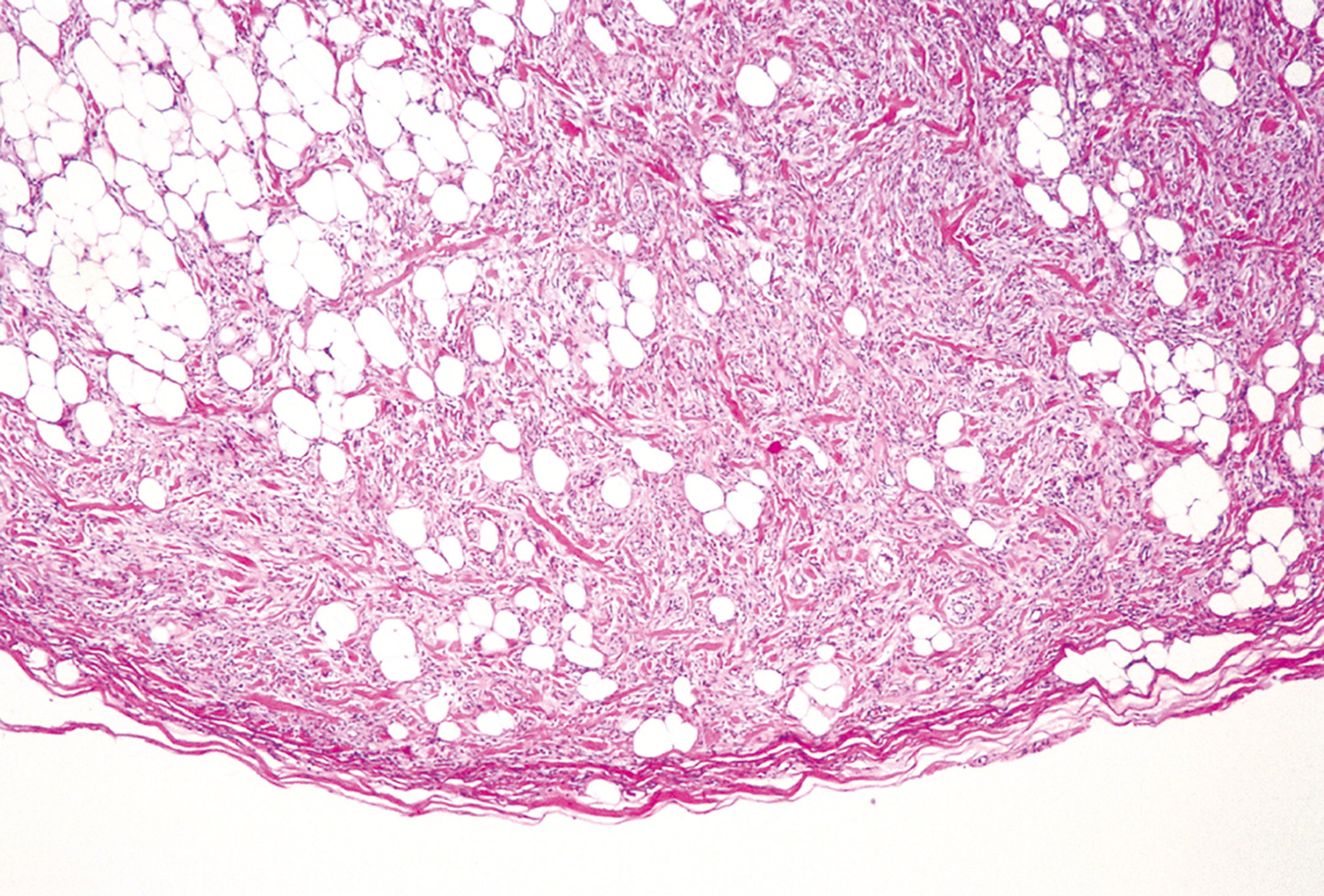 A microscopic view displays a dense fibrous tissue layer with scattered round empty spaces and a thin lower border of compact connective tissue.