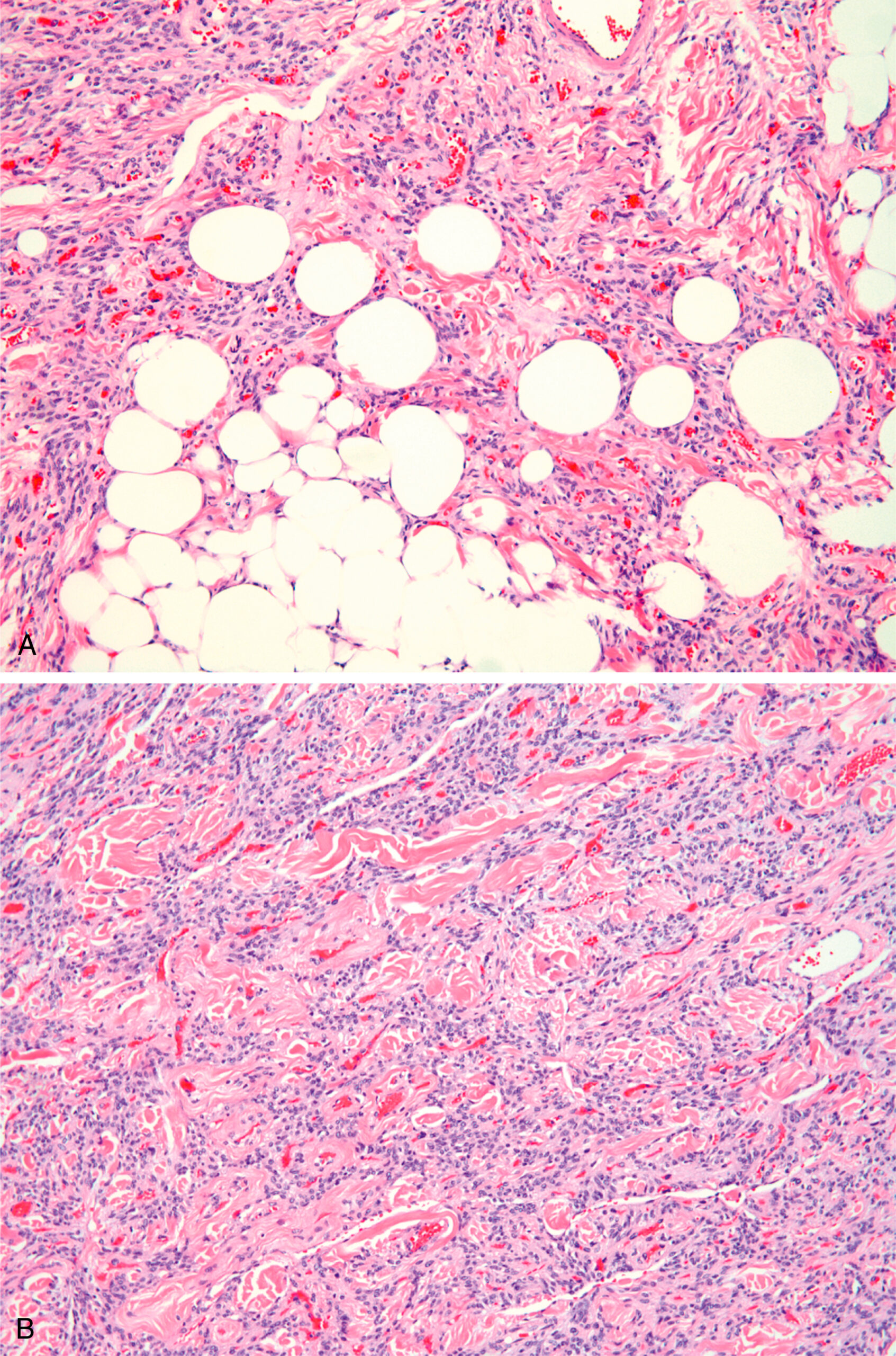 A set of two microscopic views labeled A and B displays tissue with fat cells and dense stromal components with vascular and cellular variation in spindle cell lipoma. The two microscopic views labeled A and B depict tissue differences in spindle cell lipoma. Part A contains clusters of round adipocytes within a loose fibrous stroma and scattered blood vessels. Part B displays dense fibrous tissue with fewer adipocytes and increased cellularity, with elongated nuclei and small blood vessels present throughout. Both parts highlight the variation in fat content and stromal composition.