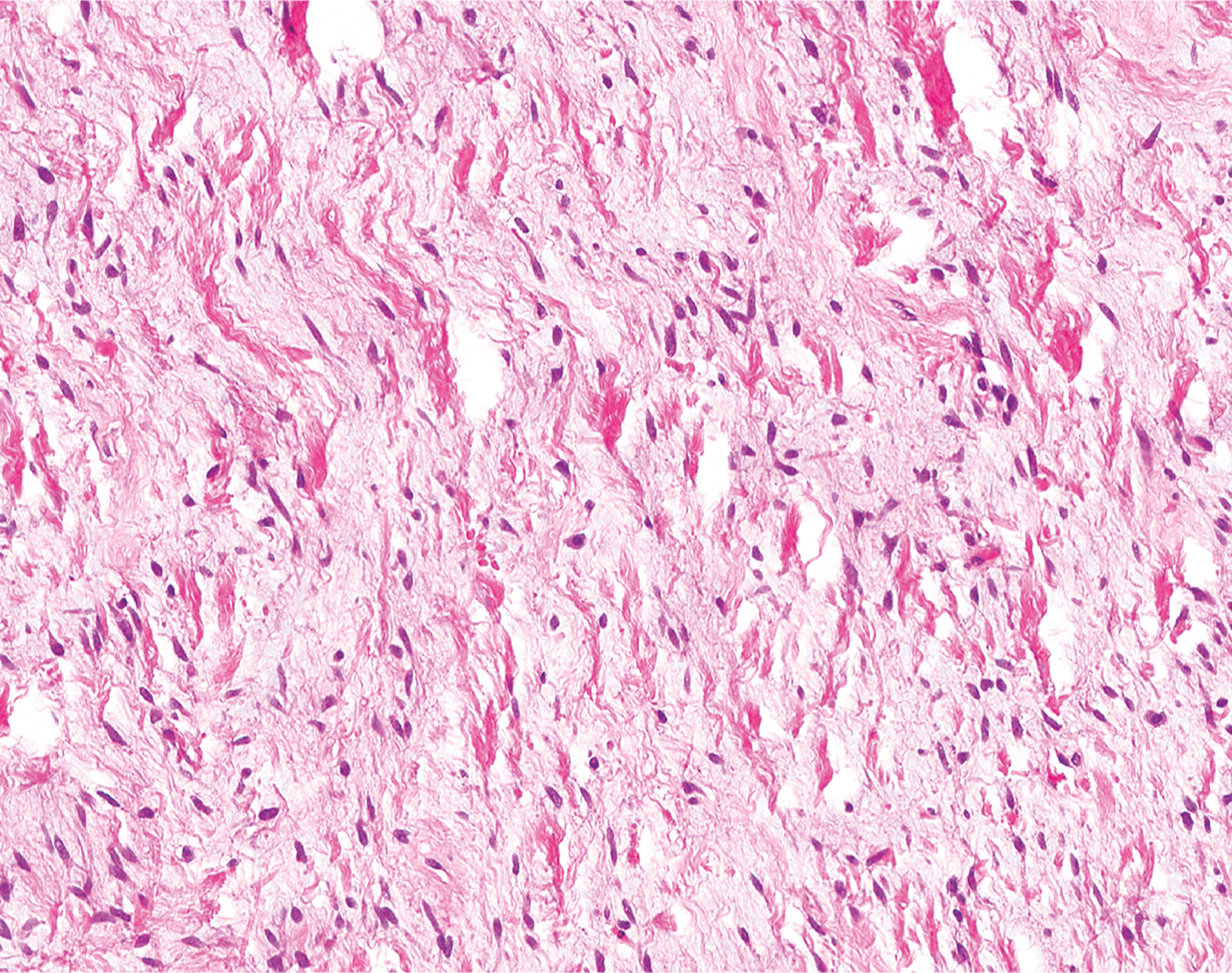A microscopic view displays dense fibrous tissue with spindle-shaped cells and scattered nuclei within a collagenous stroma.