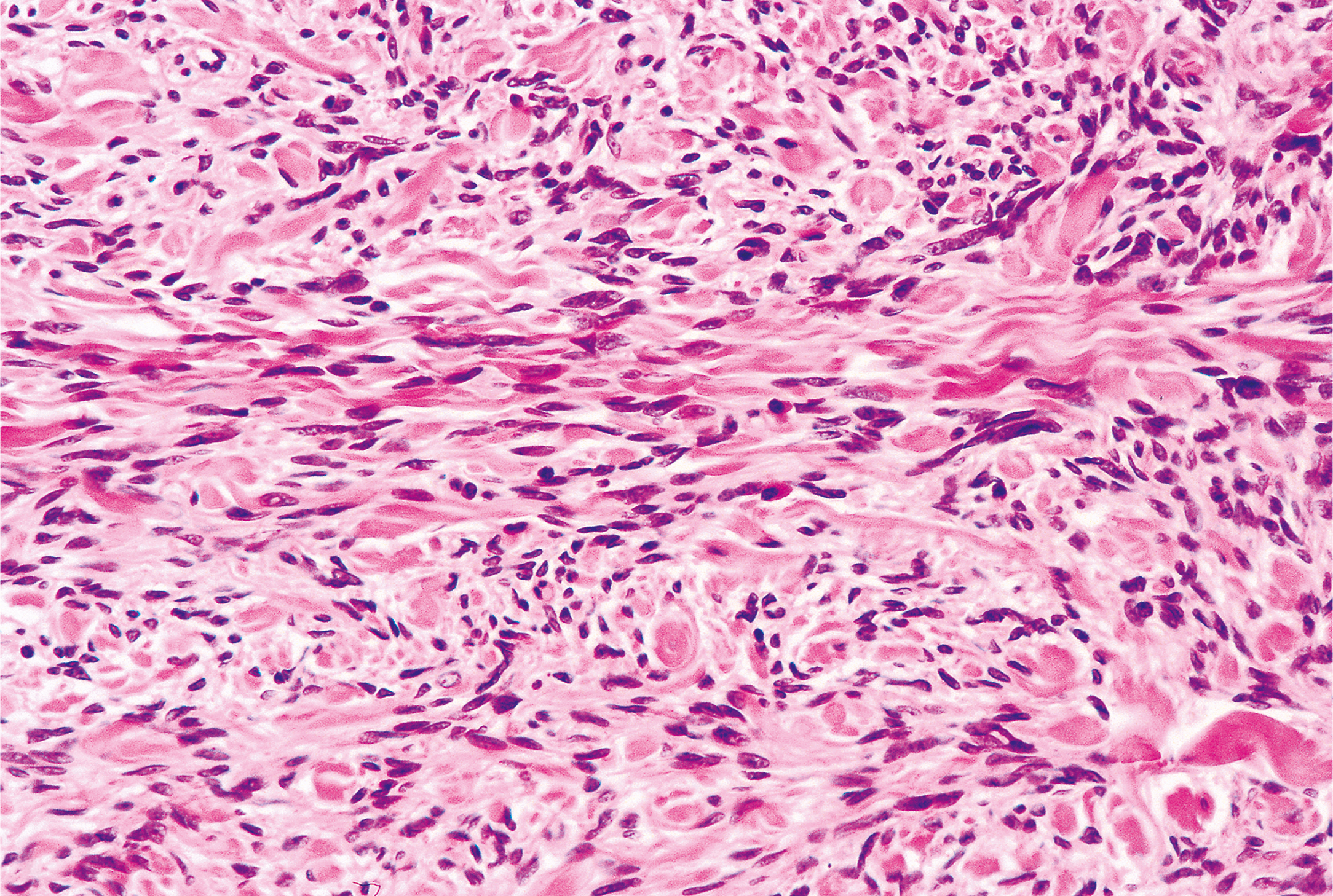 A microscopic view of densely packed spindle cells arranged in fascicles with elongated nuclei and intermixed inflammatory cells scattered throughout the fibrous stroma.