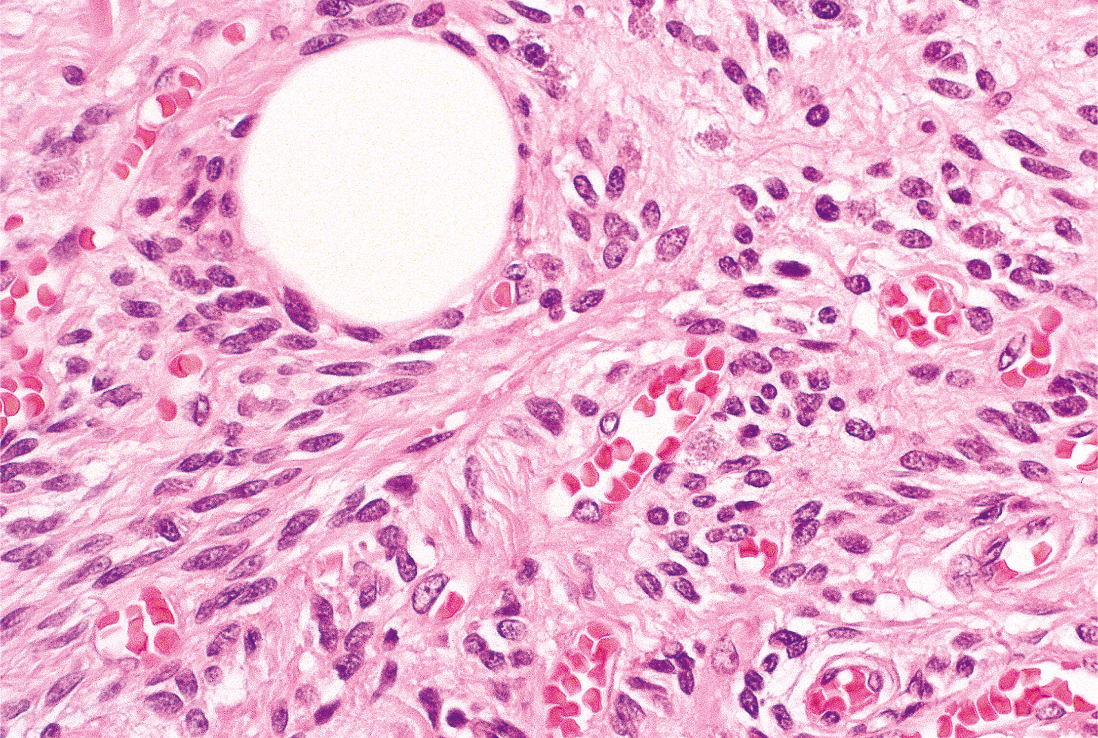 A microscopic view of spindle cells, scattered inflammatory cells, and a large round empty space near the top left amid fibrous tissue and blood vessels.