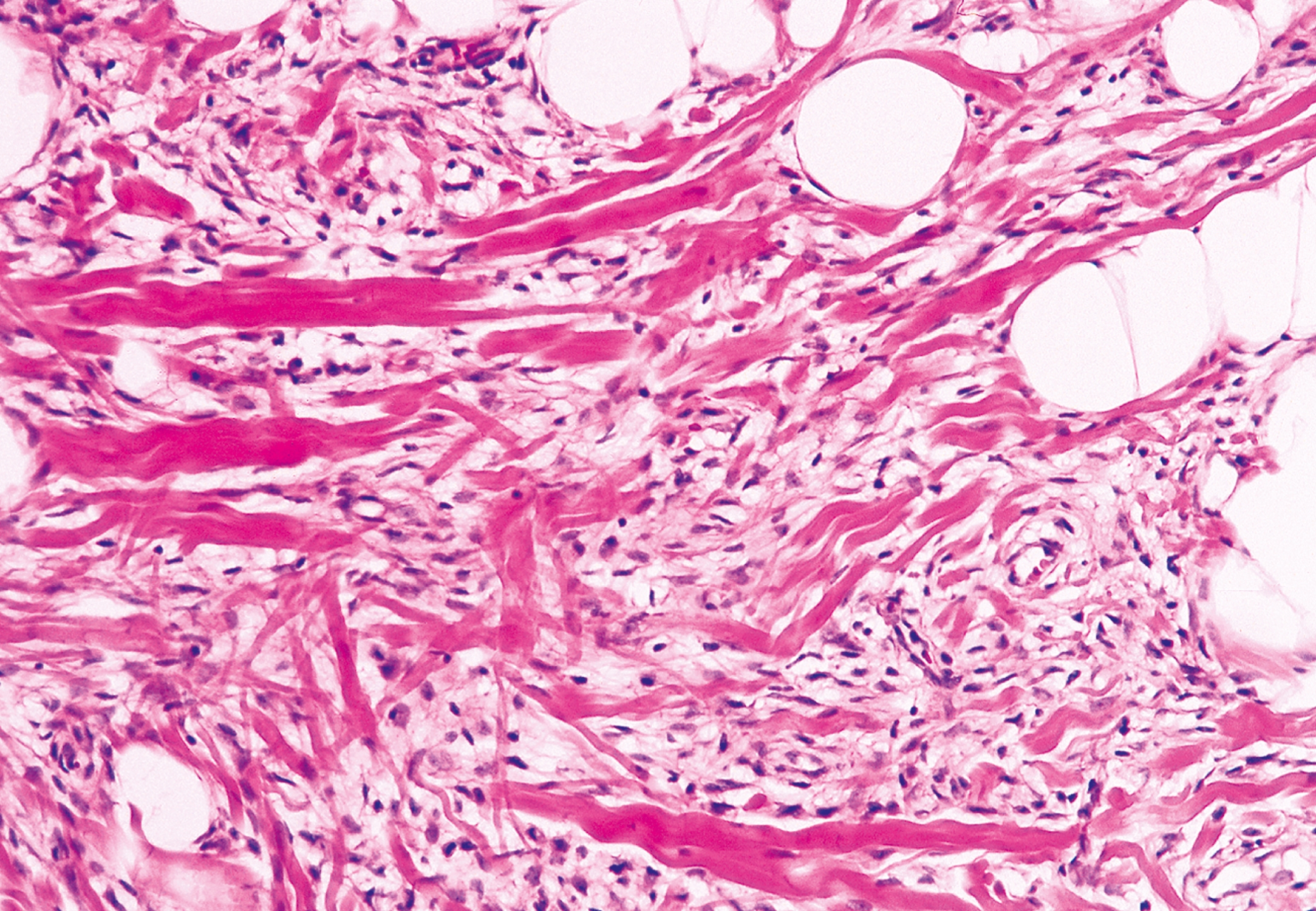 A microscopic view of thick collagen bundles, scattered spindle cells, inflammatory cells, and multiple round empty spaces in a loose fibrous background.