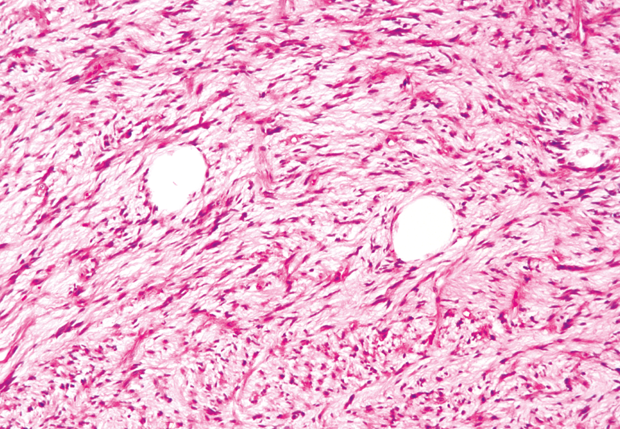 A microscopic view of compact spindle cells arranged in intersecting fascicles and two rounded empty spaces in a dense fibrous background.