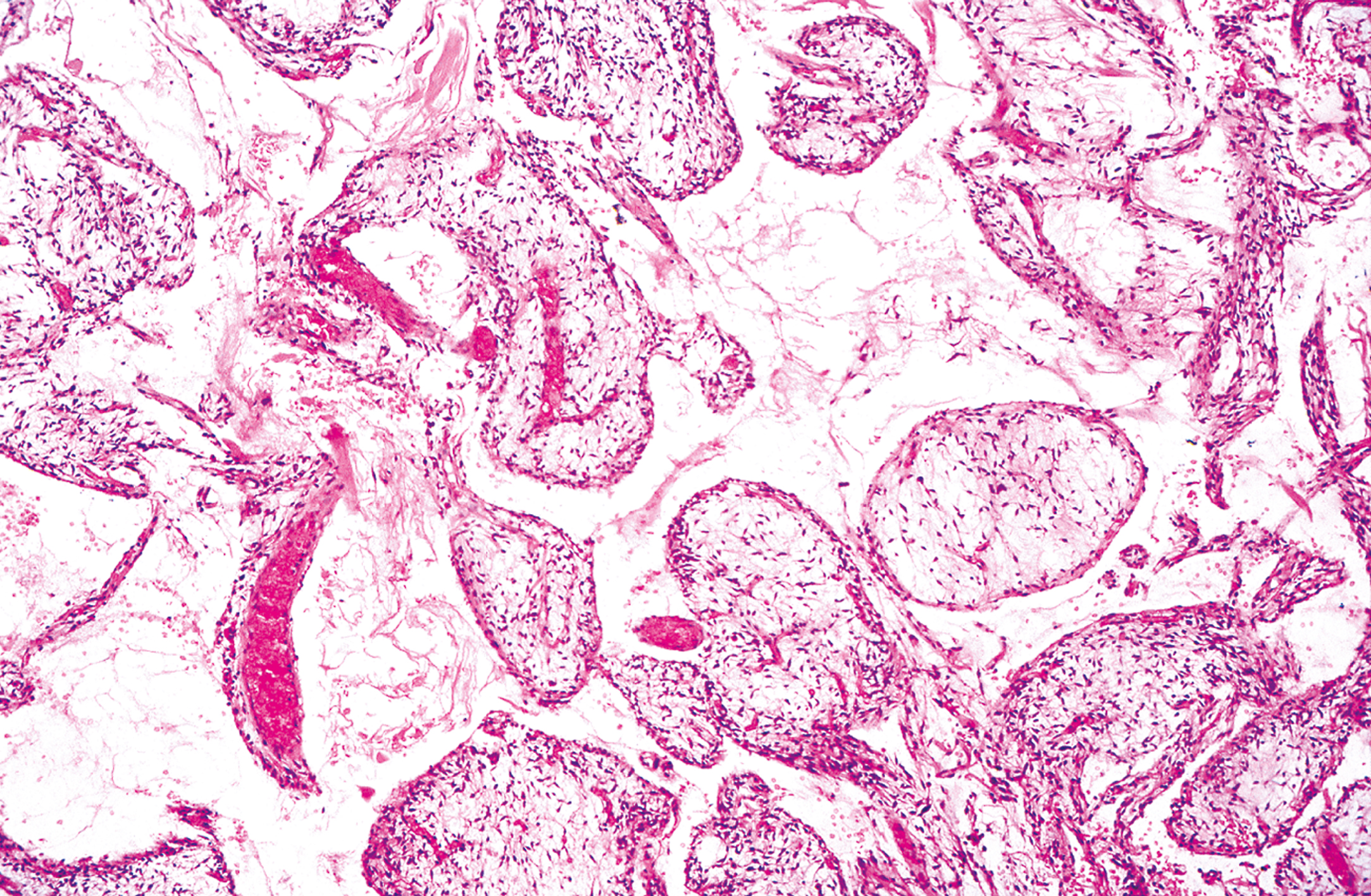 A microscopic view displays numerous enlarged chorionic villi with irregular outlines, central acellular regions, and peripheral dense cellular zones.