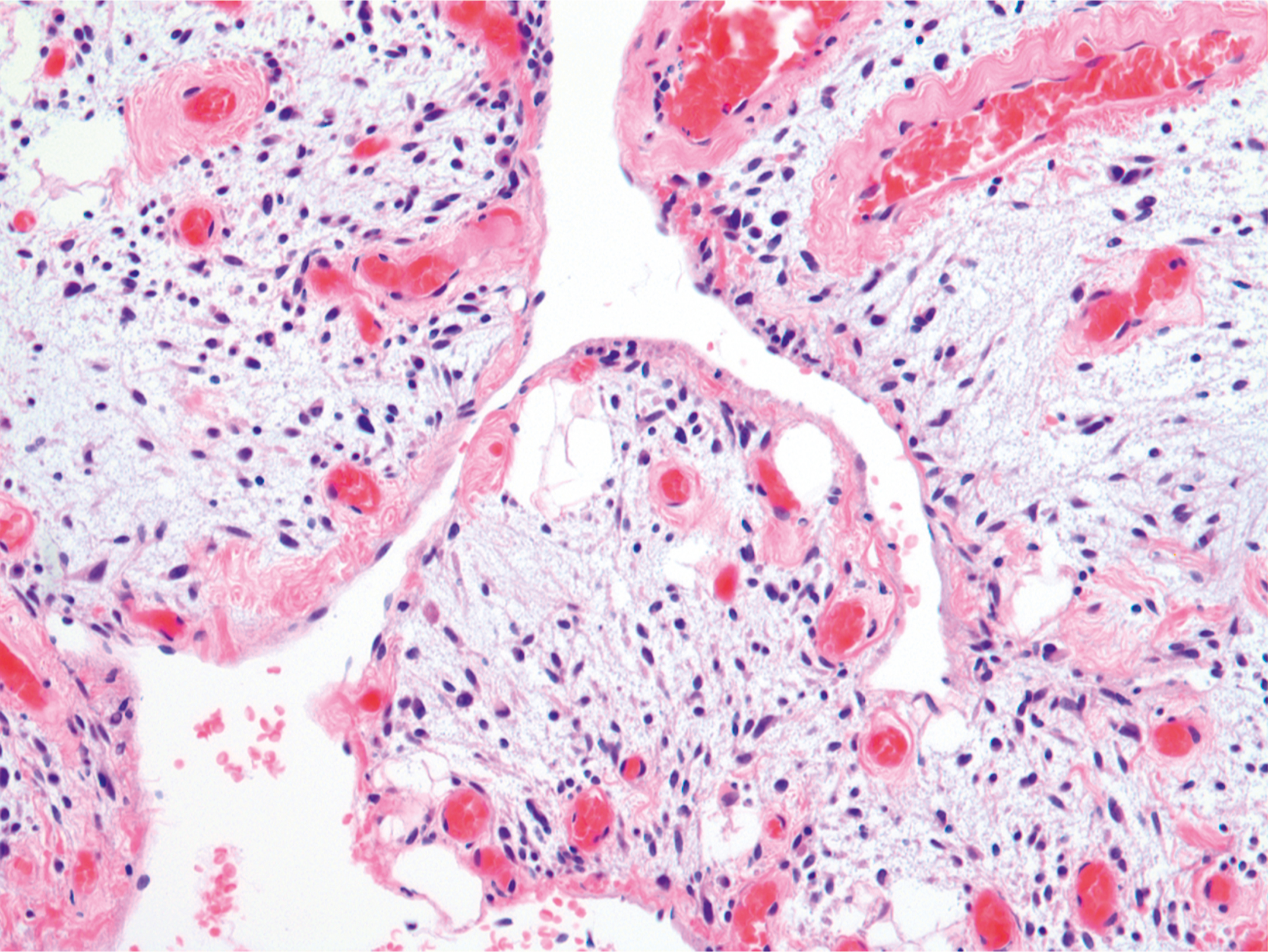 A microscopic view displays multiple chorionic villi with central fibrous stroma, peripheral trophoblastic lining, and scattered dark-staining nuclei.