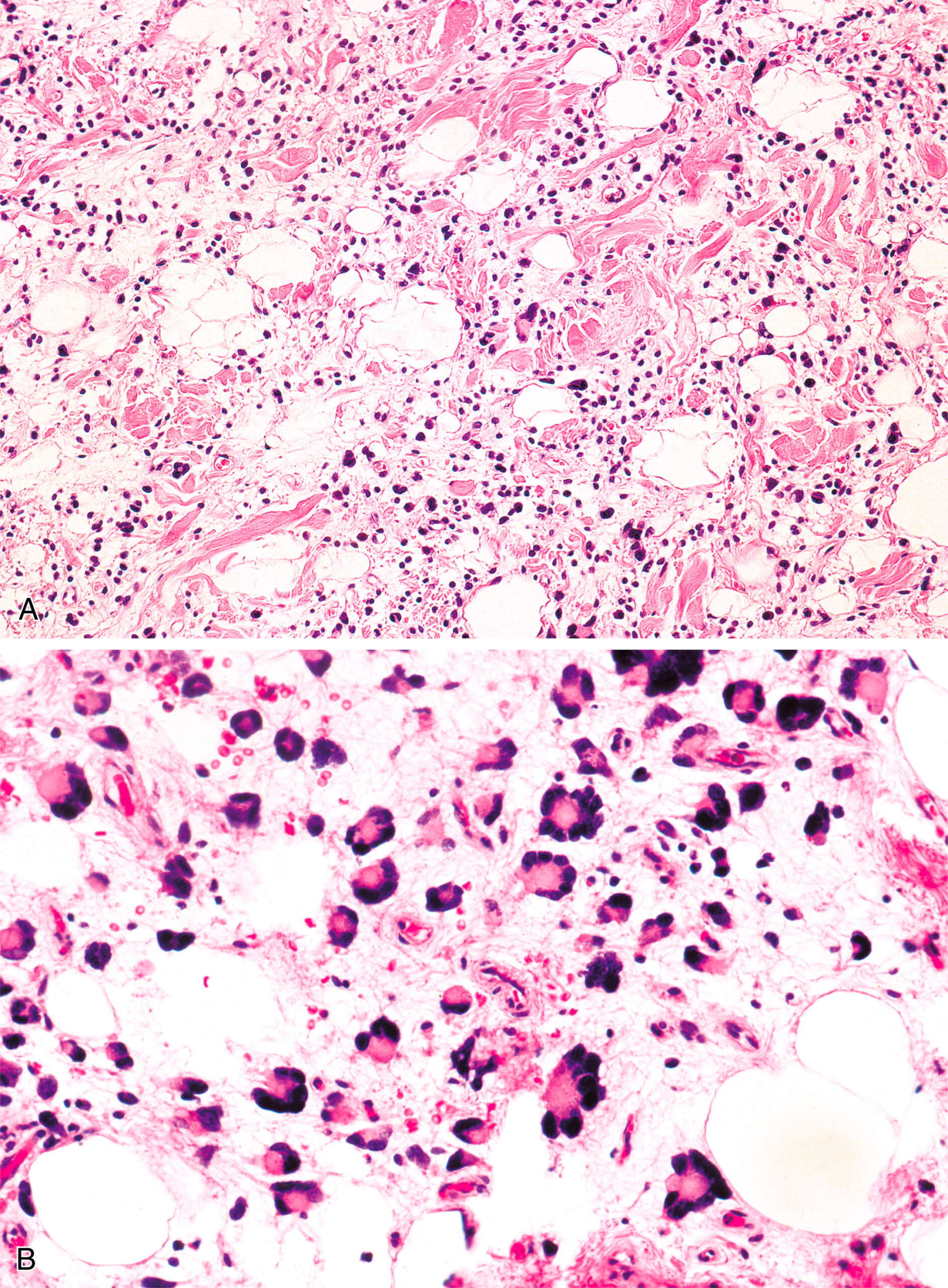 A set of two microscopic views displays clusters of vacuolated cells, fibrous stroma, and numerous dark-staining nuclei in pleomorphic lipoma. The set of two microscopic views displays pleomorphic lipoma. Part A shows a mixture of round, bubble-like mature fat cells, large irregularly shaped giant cells containing multiple nuclei, and thick, wavy collagen strands resembling twisted ropes. Part B shows numerous floret-like giant cells with nuclei arranged like flower petals scattered throughout a smooth, gelatin-like background, creating a soft, cloud-like appearance with flower-shaped cells gently embedded within it.