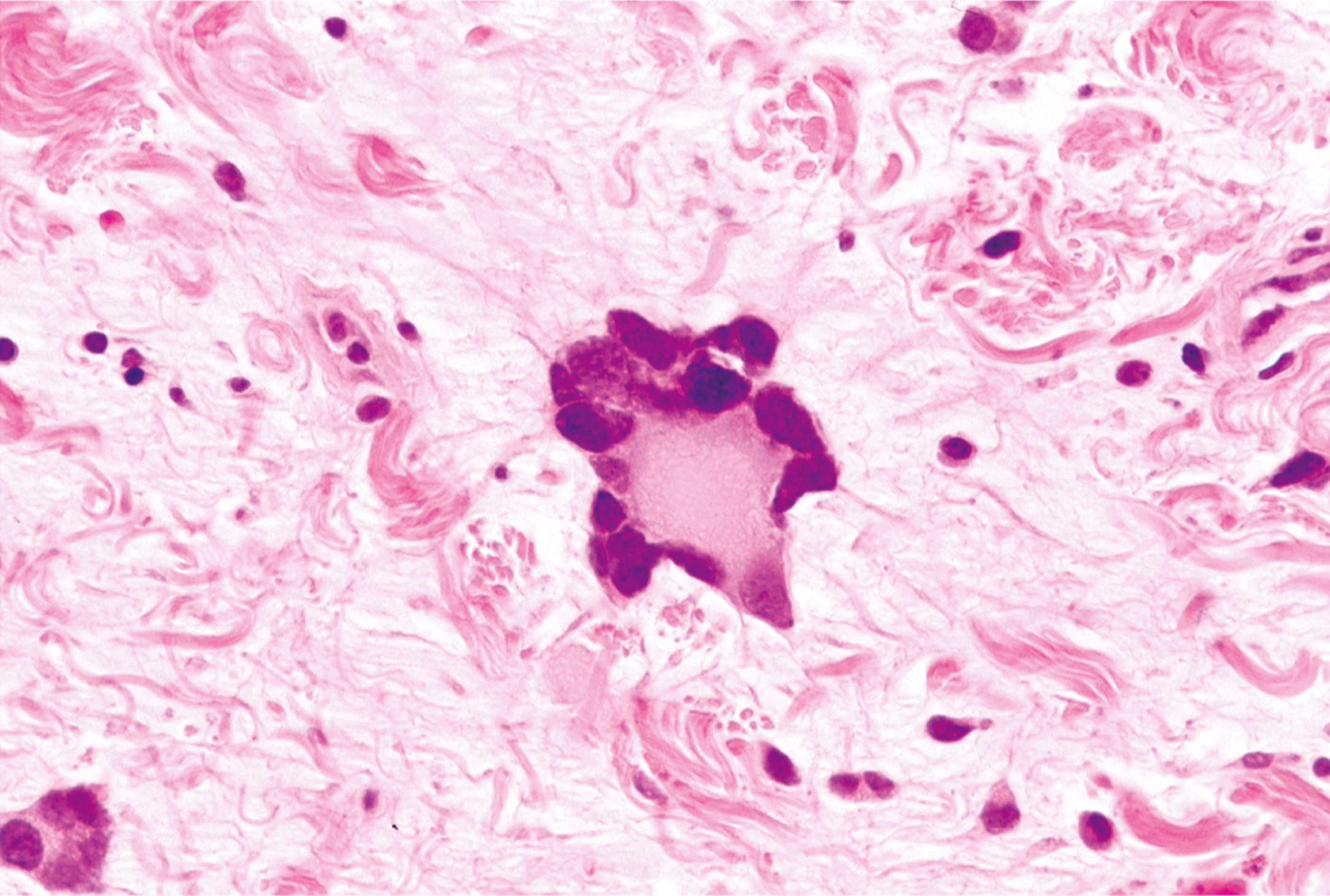 A microscopic view displays a central cluster of large multinucleated cells surrounded by fibrous stroma with scattered elongated nuclei.