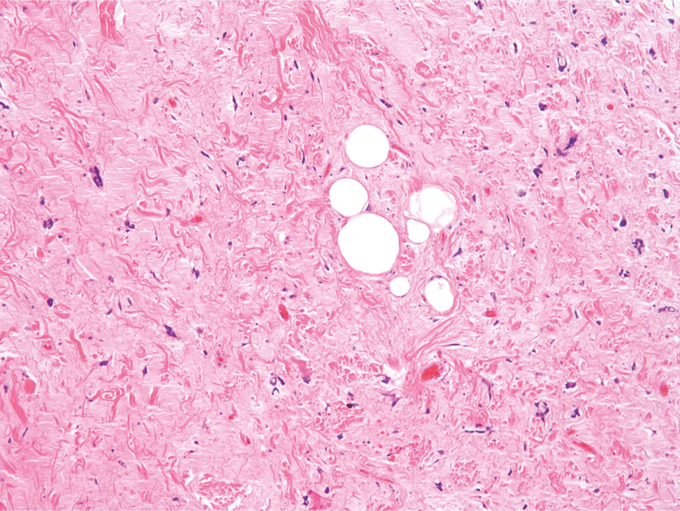 A microscopic view displays fibrous stroma with scattered spindle cells and multiple round clear spaces clustered centrally.