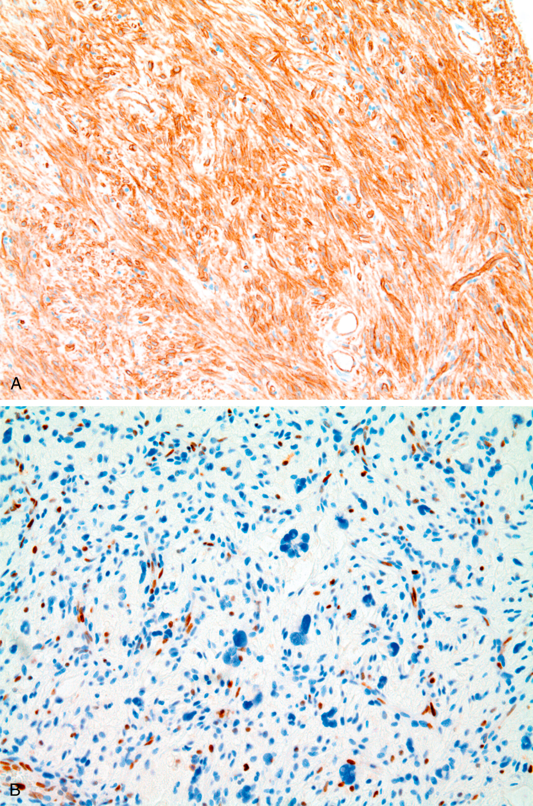 A set of two microscopic views display spindle cell lipoma. The set of two microscopic views labeled A and B present spindle cell lipoma. Part A displays densely arranged spindle-shaped cells with diffuse cytoplasmic staining in a fibrous stroma. The staining pattern appears uniform and widespread throughout the section. Part B contains loosely arranged cells with oval to elongated nuclei and scattered nuclear staining in a more cellular matrix. The immunoreactivity in part B appears focal and limited to certain nuclei, in contrast to the diffuse cytoplasmic pattern seen in part A.