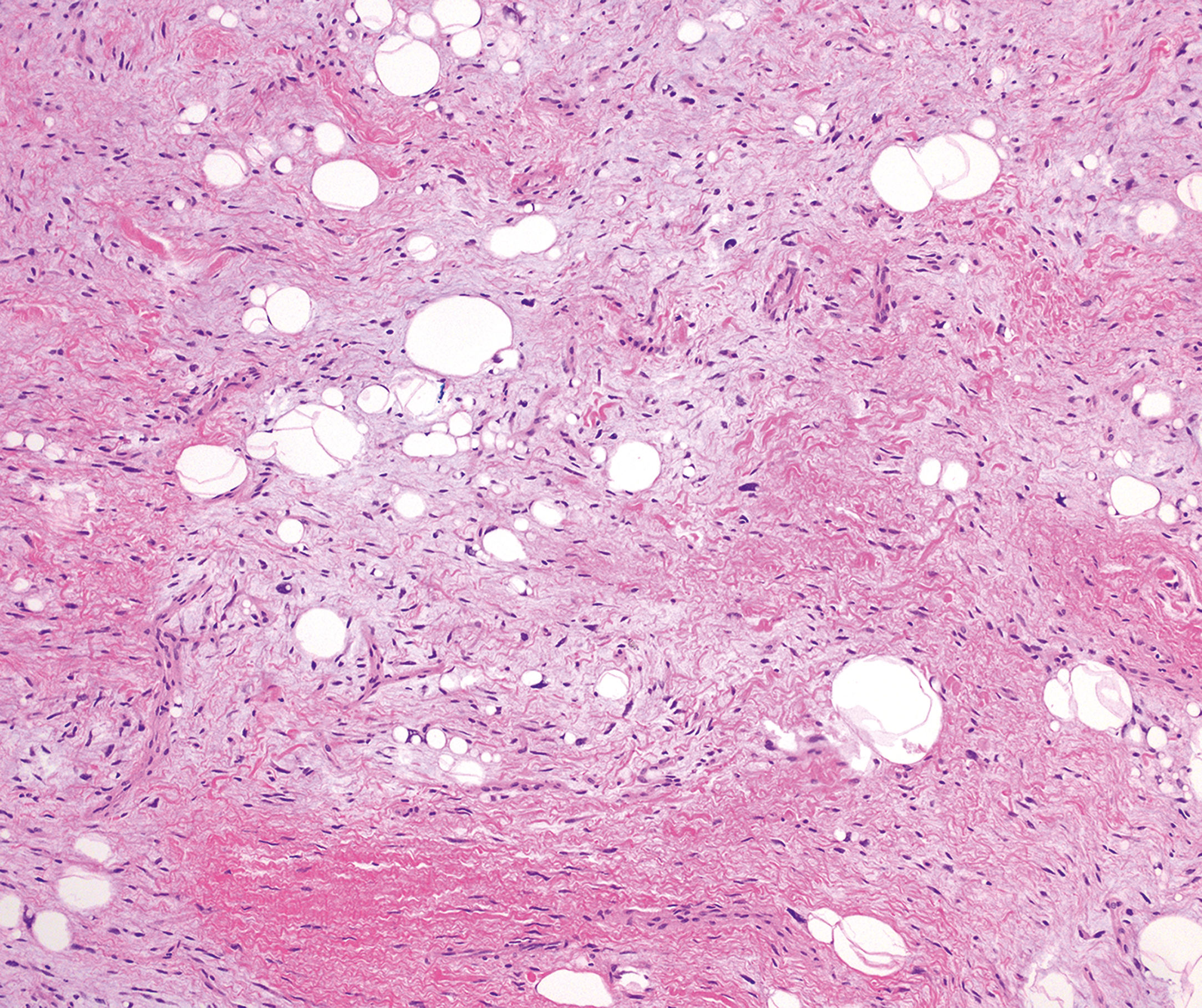 A microscopic view displays fibrous stroma with scattered adipocytes and spindle-shaped cells in a loose arrangement.