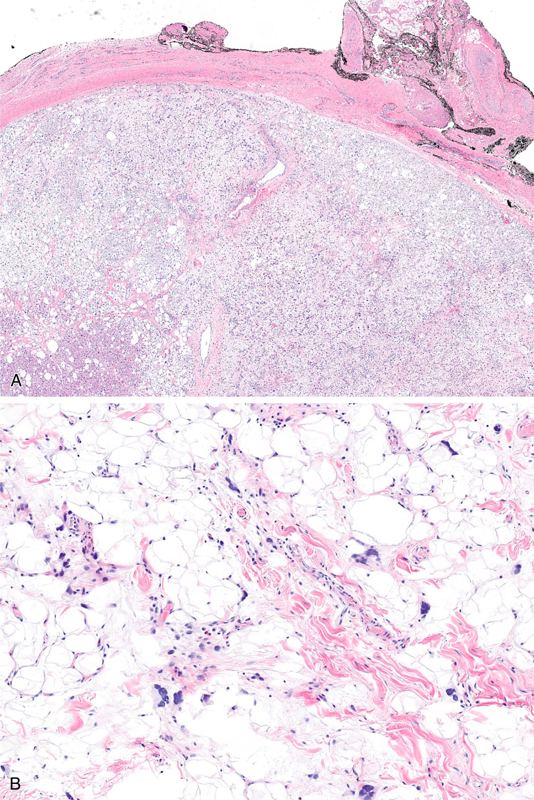 A set of two microscopic views displays a dermal tumor, adipose-rich tissue, vascular structures, and round cell infiltrates with varying densities and patterns in a pleomorphic lipomatous tumor. The set of two microscopic views labeled A and B displays distinct tissue features of a pleomorphic lipomatous tumor. Part A displays a dome-shaped dermal lesion located beneath an intact epidermis, suggesting a well-defined growth within the skin layer. Part B reveals abundant adipocytes and scattered round cells embedded in a loose connective tissue matrix, indicating a softer, possibly reactive or supportive tissue environment with mixed cellular components.