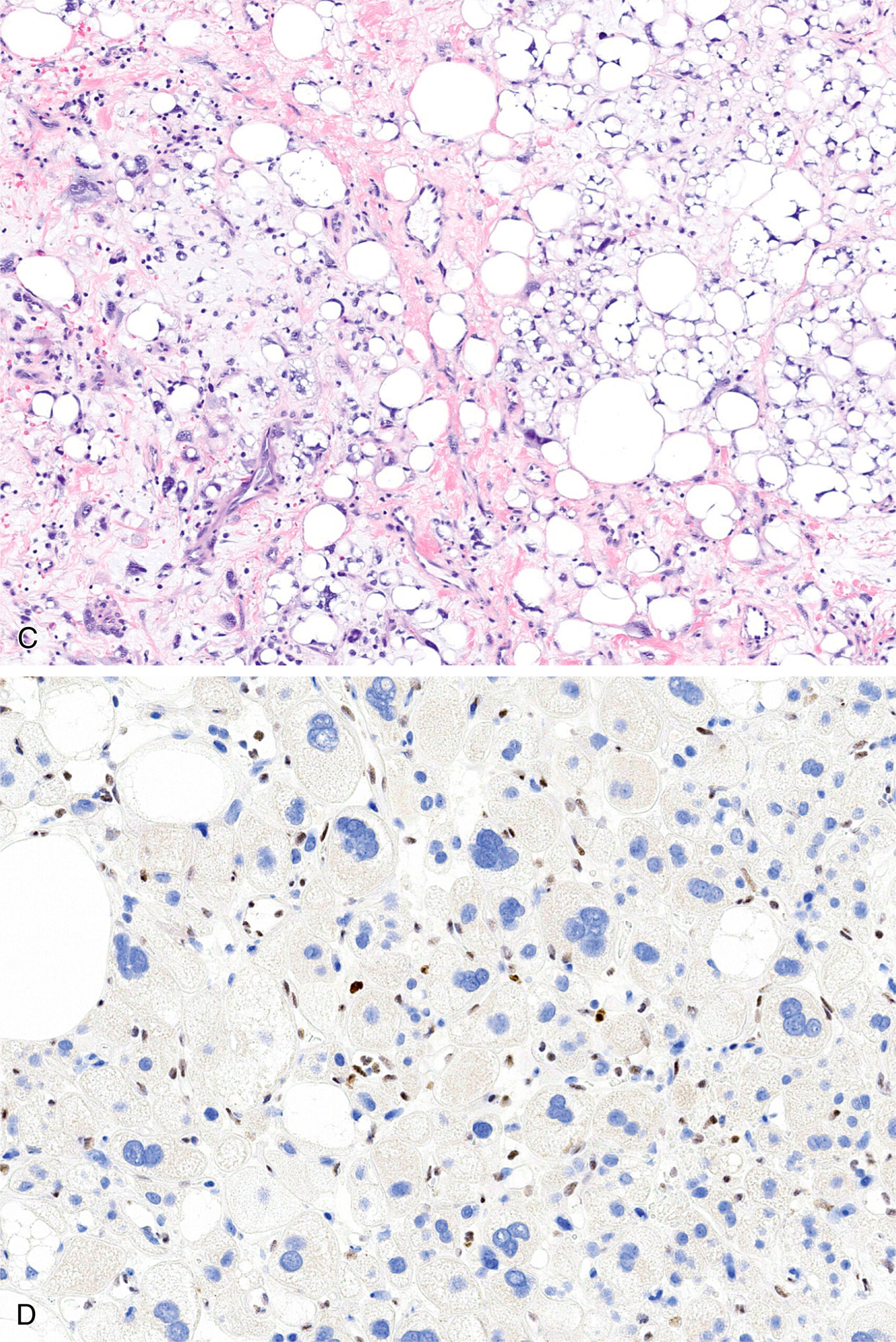 A set of two microscopic views displays a dermal tumor, adipose-rich tissue, vascular structures, and round cell infiltrates with varying densities and patterns in a pleomorphic lipomatous tumor. The set of two microscopic views labeled A and B displays distinct tissue features of a pleomorphic lipomatous tumor. Part A displays a dome-shaped dermal lesion located beneath an intact epidermis, suggesting a well-defined growth within the skin layer. Part B reveals abundant adipocytes and scattered round cells embedded in a loose connective tissue matrix, indicating a softer, possibly reactive or supportive tissue environment with mixed cellular components.
