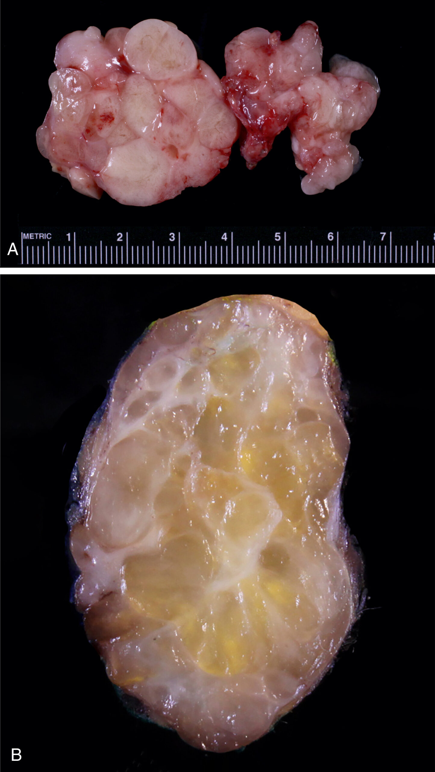 A set of two gross pathology photographs display lipoblastoma. The two gross pathology photographs labeled A and B show lipoblastoma. Part A presents a resected soft tissue specimen placed against a metric ruler marked from zero to eight. The specimen is irregularly multilobulated with multiple rounded nodules and smooth external surfaces. It appears well-defined and exhibits a soft consistency. Part B displays the cut surface of a larger lobulated specimen, which is ovoid in shape and well circumscribed. The internal architecture is distinctly lobulated with alternating areas of soft tissue and fibrous septations that divide the mass into nodular compartments. The surface is glistening, and there is no evidence of necrosis or hemorrhage.