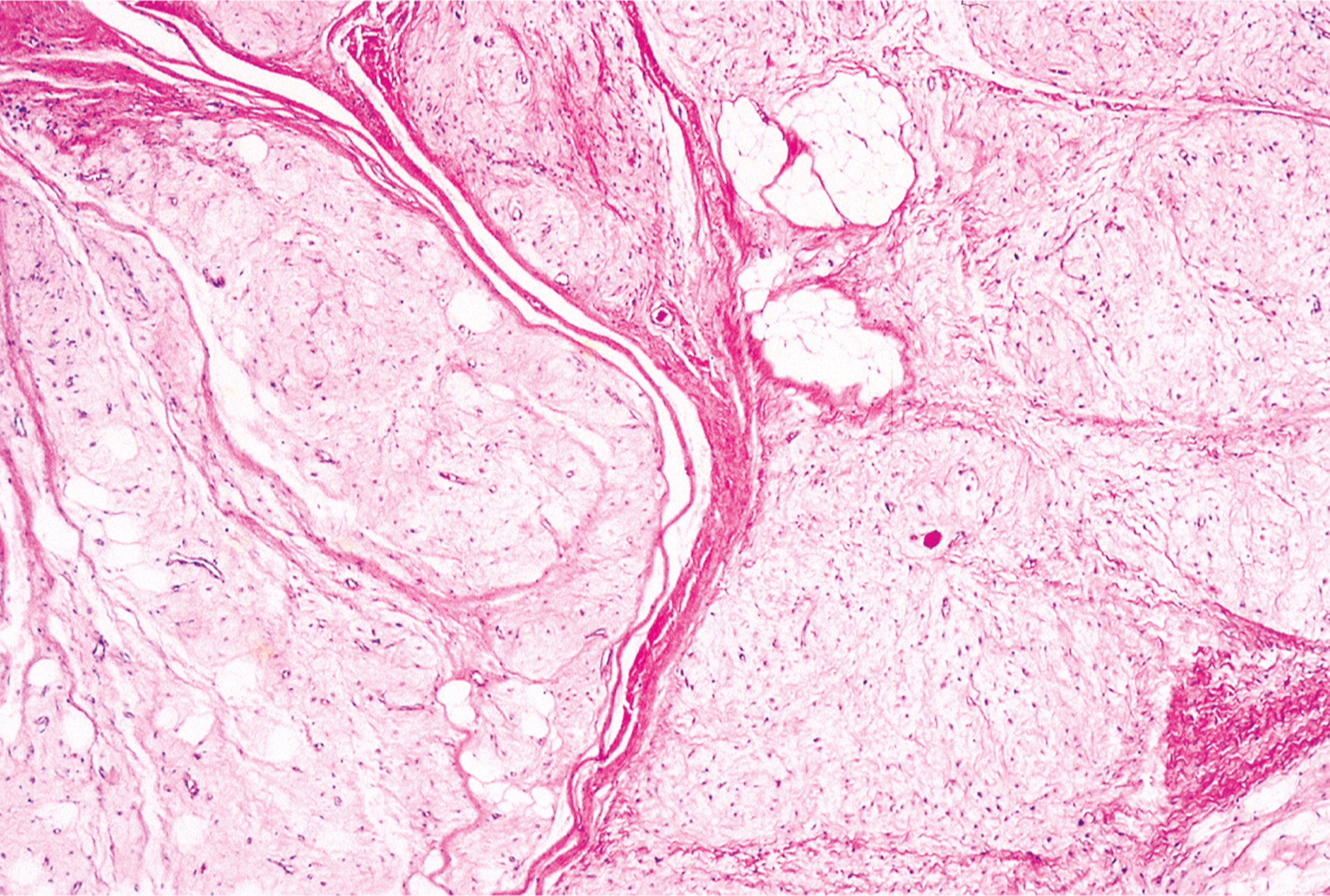 A microscopic view of lobulated stroma, scattered adipocytes, and fibrous septa.