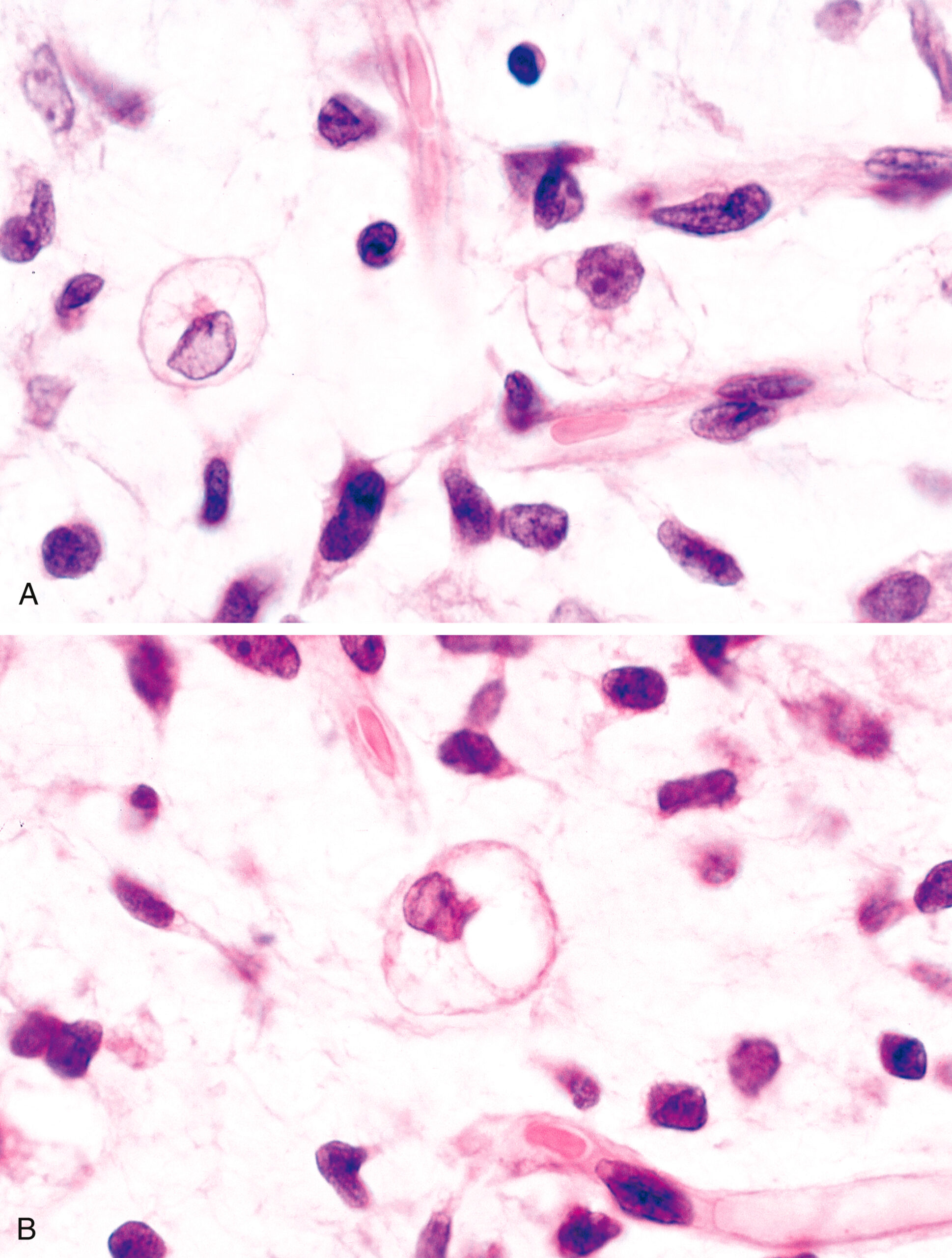 The histological image displays four high-magnification panels of hematoxylin and eosin-stained sections. Panels A and B on the left show tumor cells containing large intracytoplasmic vacuoles with eccentrically displaced, hyperchromatic nuclei. Panels C and D on the right reveal similar features, with multiple cells exhibiting round vacuoles, suggesting lipoblast-like morphology. The background stroma is loosely arranged with scattered spindle cells, and the nuclear atypia is variable. These findings are consistent with a lipogenic sarcoma. A high-magnification histological view showing round intracytoplasmic vacuoles displacing nuclei in tumor cells across four panels.