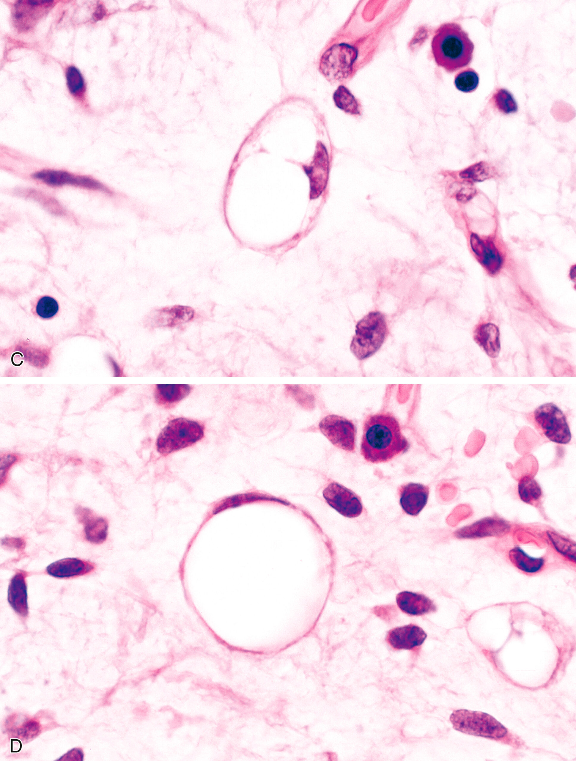 The histological image displays four high-magnification panels of hematoxylin and eosin-stained sections. Panels A and B on the left show tumor cells containing large intracytoplasmic vacuoles with eccentrically displaced, hyperchromatic nuclei. Panels C and D on the right reveal similar features, with multiple cells exhibiting round vacuoles, suggesting lipoblast-like morphology. The background stroma is loosely arranged with scattered spindle cells, and the nuclear atypia is variable. These findings are consistent with a lipogenic sarcoma. A high-magnification histological view showing round intracytoplasmic vacuoles displacing nuclei in tumor cells across four panels.
