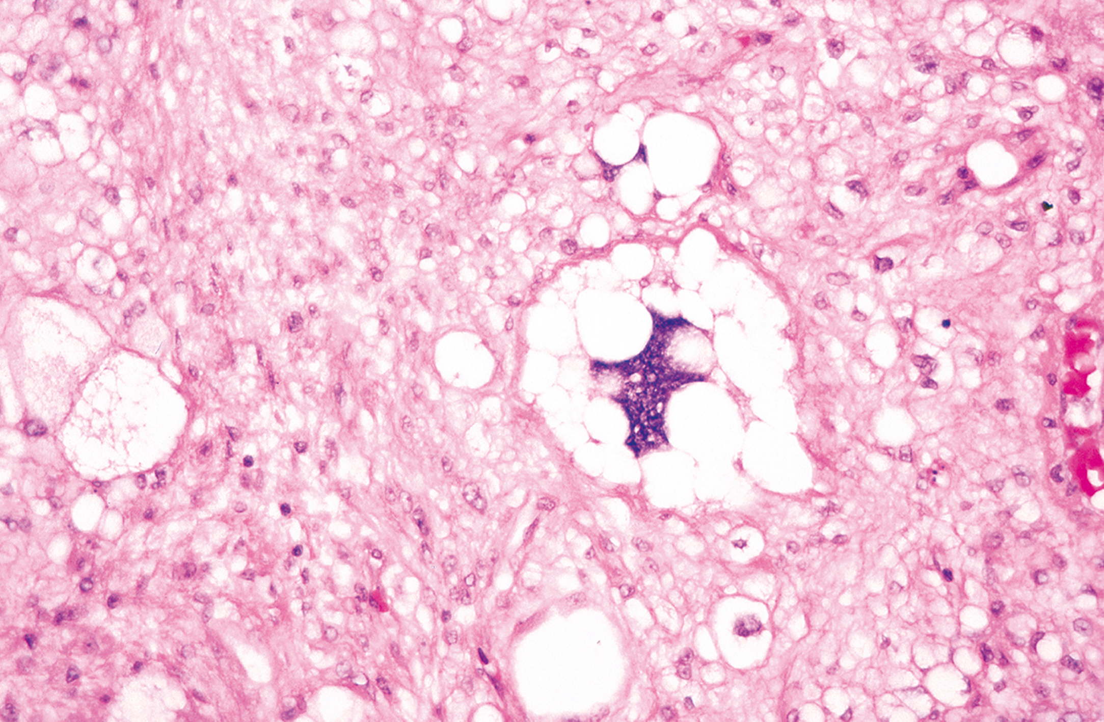 A microscopic view exhibits cells with dark nuclei and large central areas under a microscope, with numerous round structures and fibrous surroundings scattered throughout.