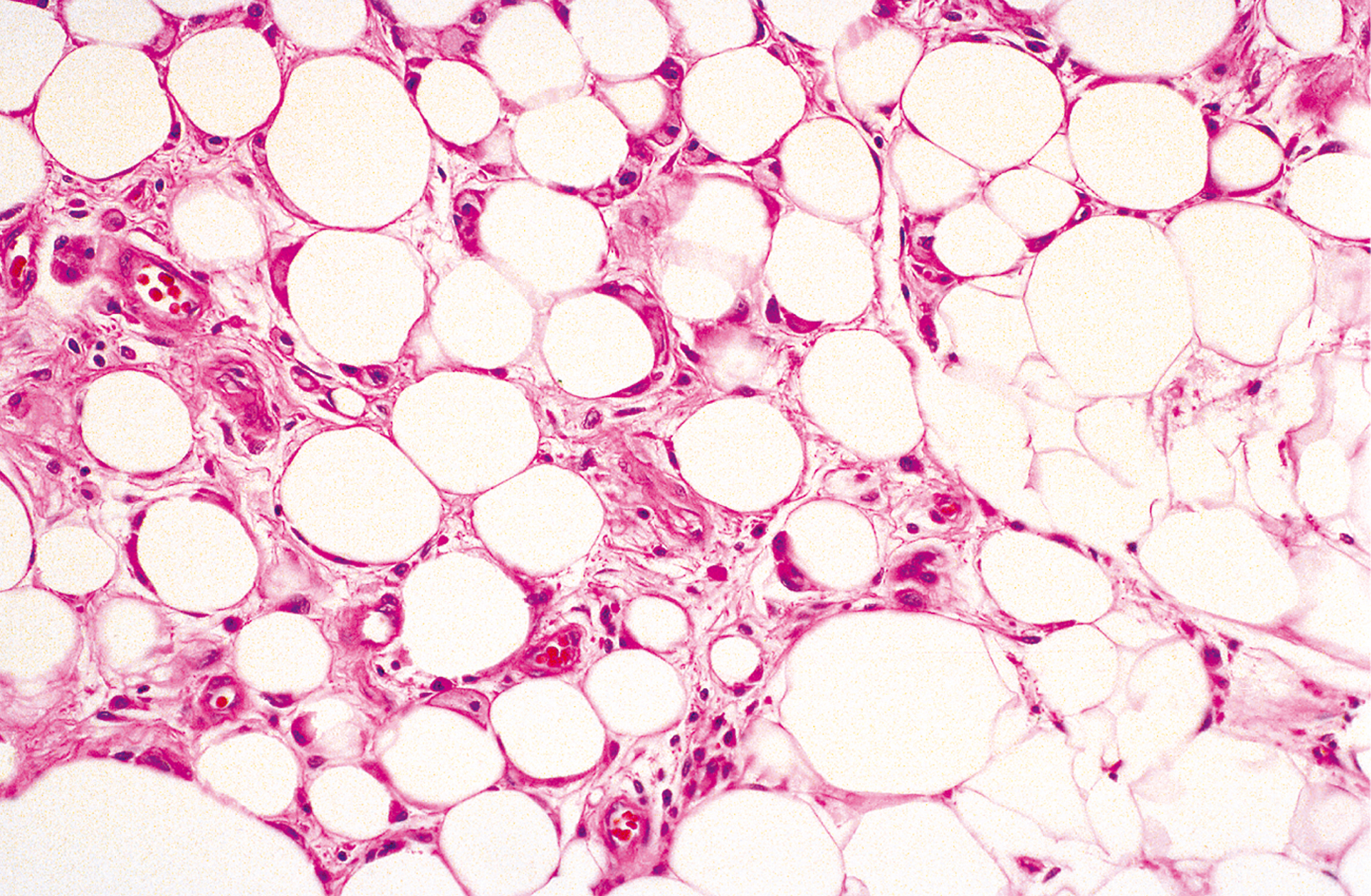 A microscopic view exhibits numerous round cells of varying sizes and dark nuclei under a microscope, surrounded by fibrous structures.