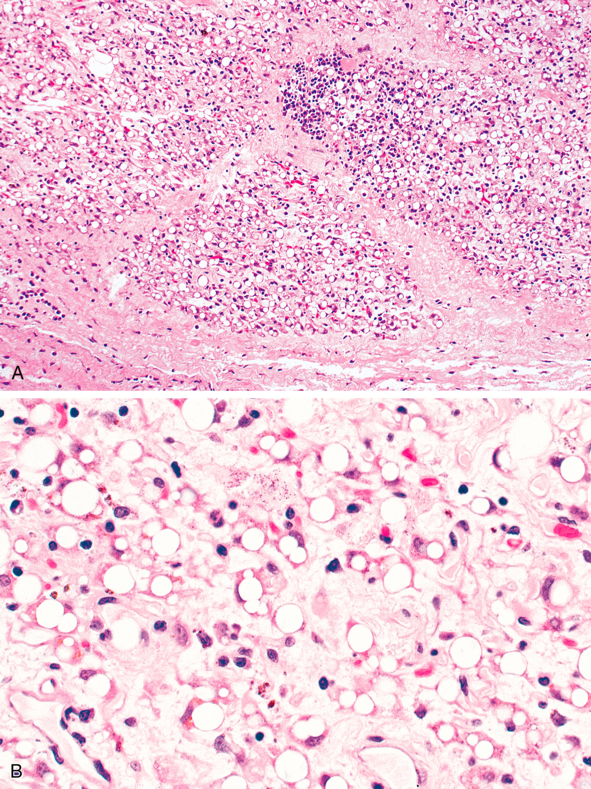 Two microscopic views reveal the small round fat vacuoles clusters in Part A. Part B is a magnified view of the same sample and exhibits pigmentation spots around the fat vacuoles clusters.