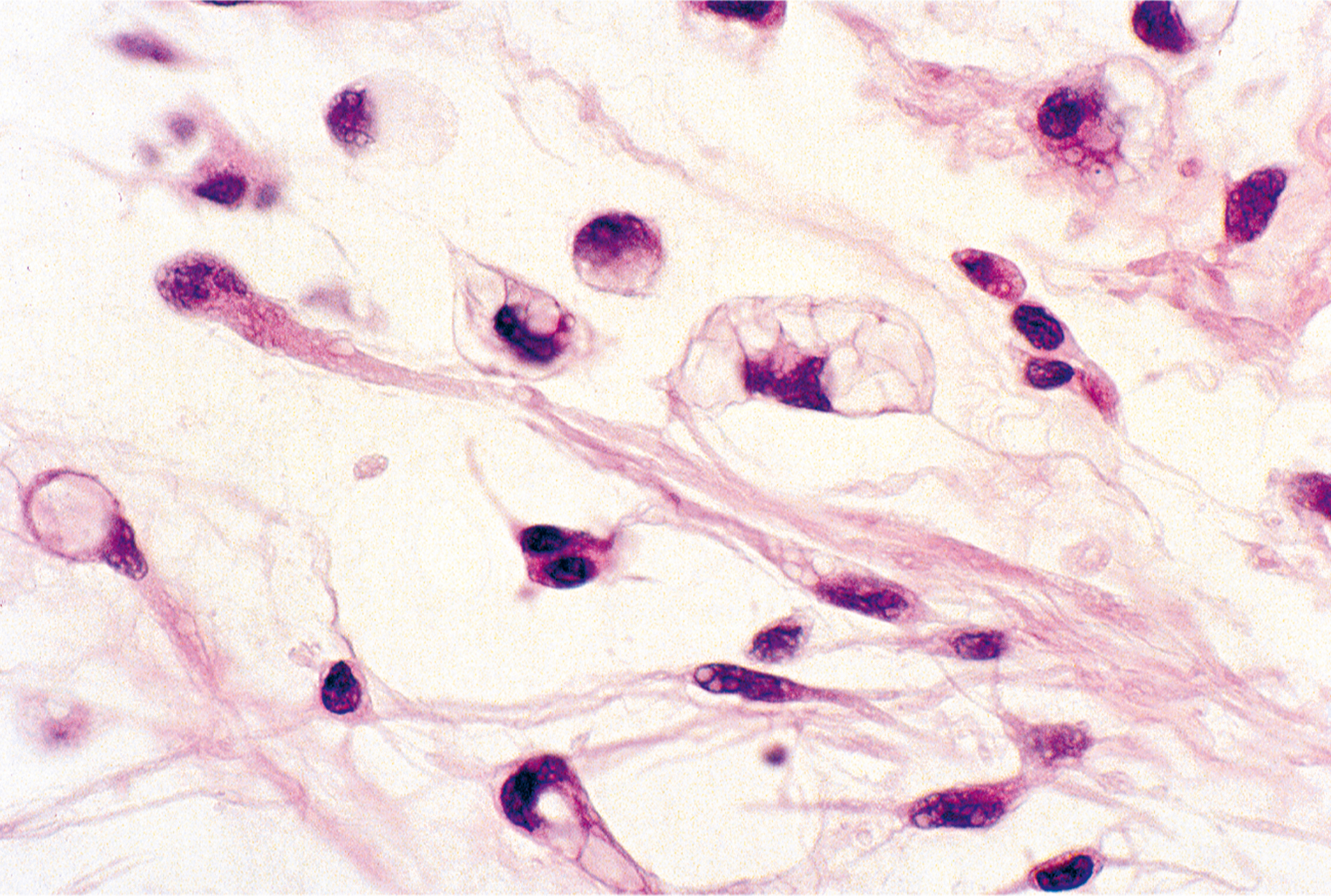 A microscopic view exhibits elongated cells with dark nuclei and fibrous structures under a microscope, with scattered round cells present.