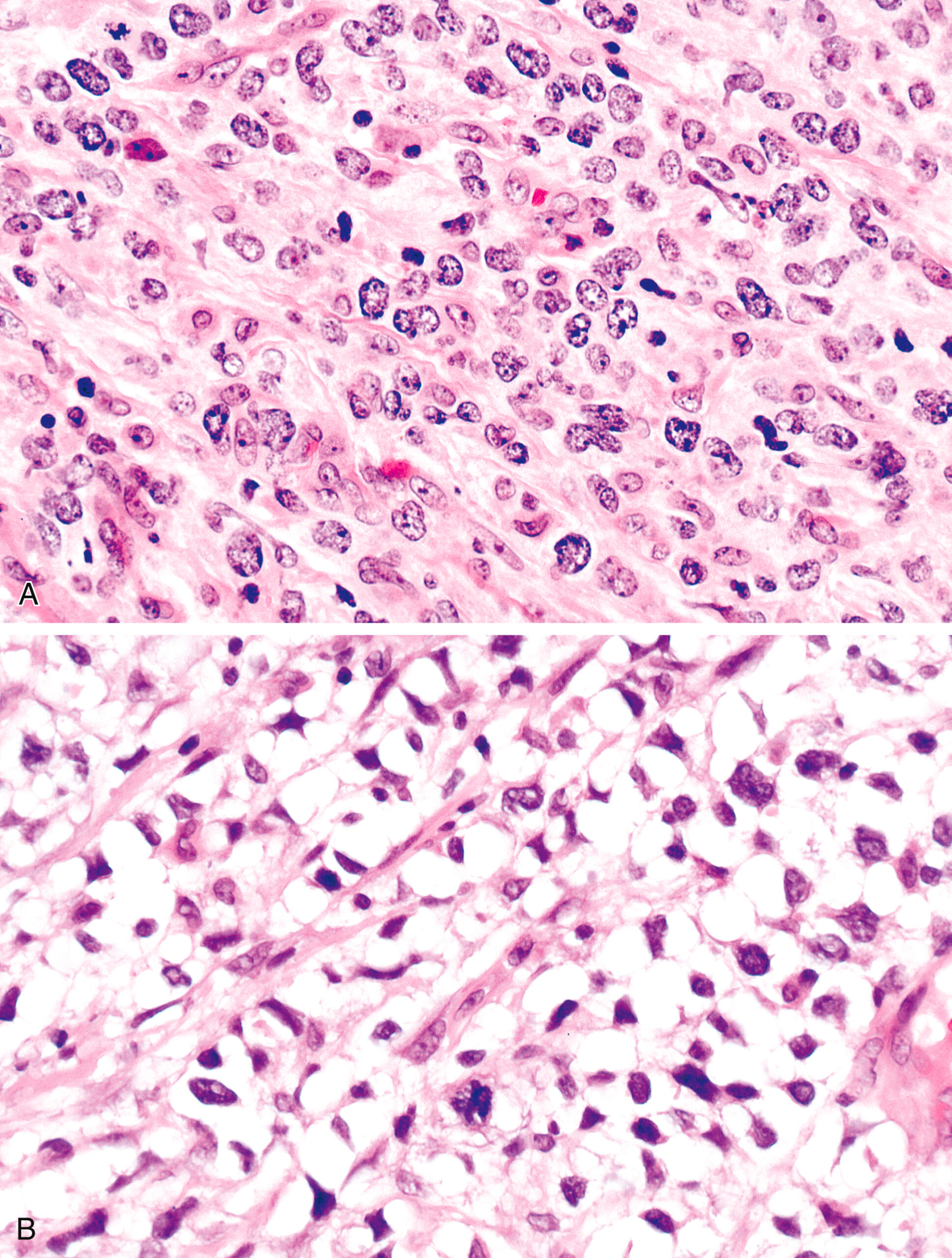 A panel of two microscopic views exhibits densely packed cells with dark nuclei under a microscope. The panel consists of two tissue samples, A and B, both viewed under a microscope. Part A contains densely packed cells with dark nuclei spread evenly across the field, creating a consistent pattern. The cellular arrangement appears uniform, with nuclei varying slightly in size. Part B presents a similar density of cells, but with varied cell sizes and dark nuclei distributed irregularly. The field includes open spaces between some cells, adding contrast to the layout. The labels Part A and Part B guide the viewer from top to bottom, indicating a shift in cellular organization.