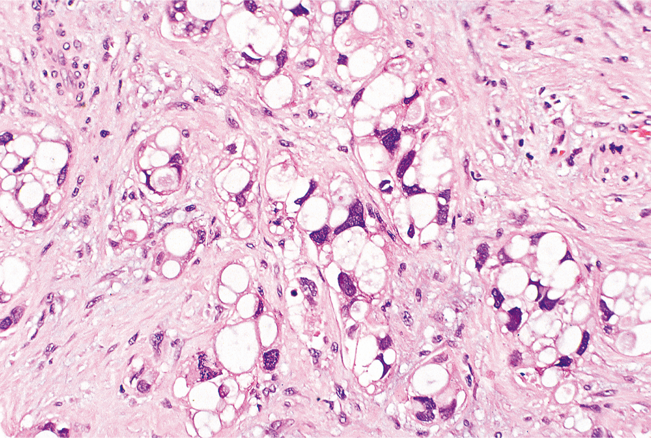A microscopic views exhibits numerous round cells with dark nuclei and fibrous structures under a microscope, with varying cell sizes present.