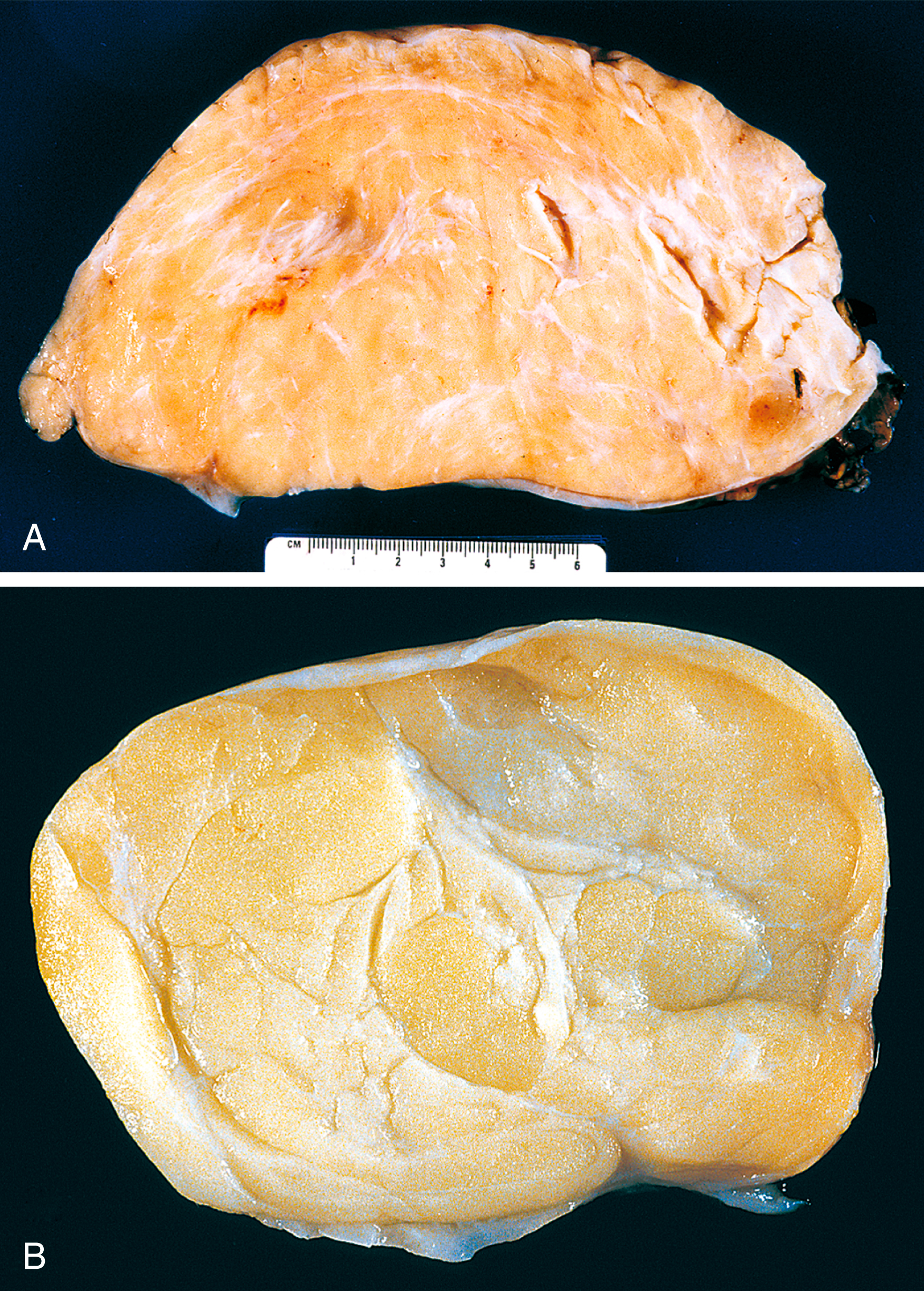 A panel of two fat masses exhibit the structure in two different views. Parts A reveals fibrous bands with gaps with a centimeter ruler at the bottom. Part B exhibits gelatinous and soft structure.