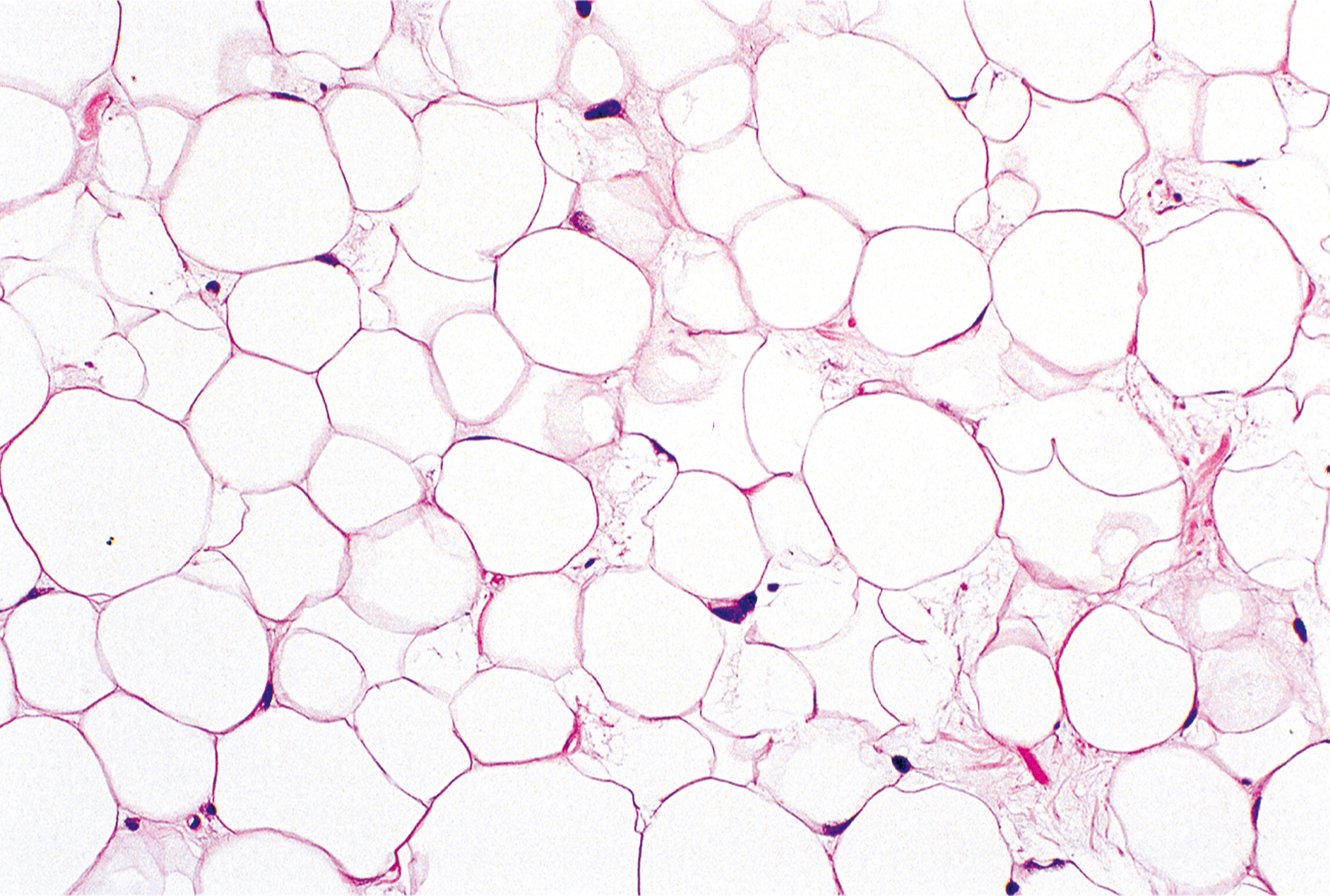 A microscopic view exhibits numerous round cells with dark nuclei and fibrous structures under a microscope, with cells varying in size.