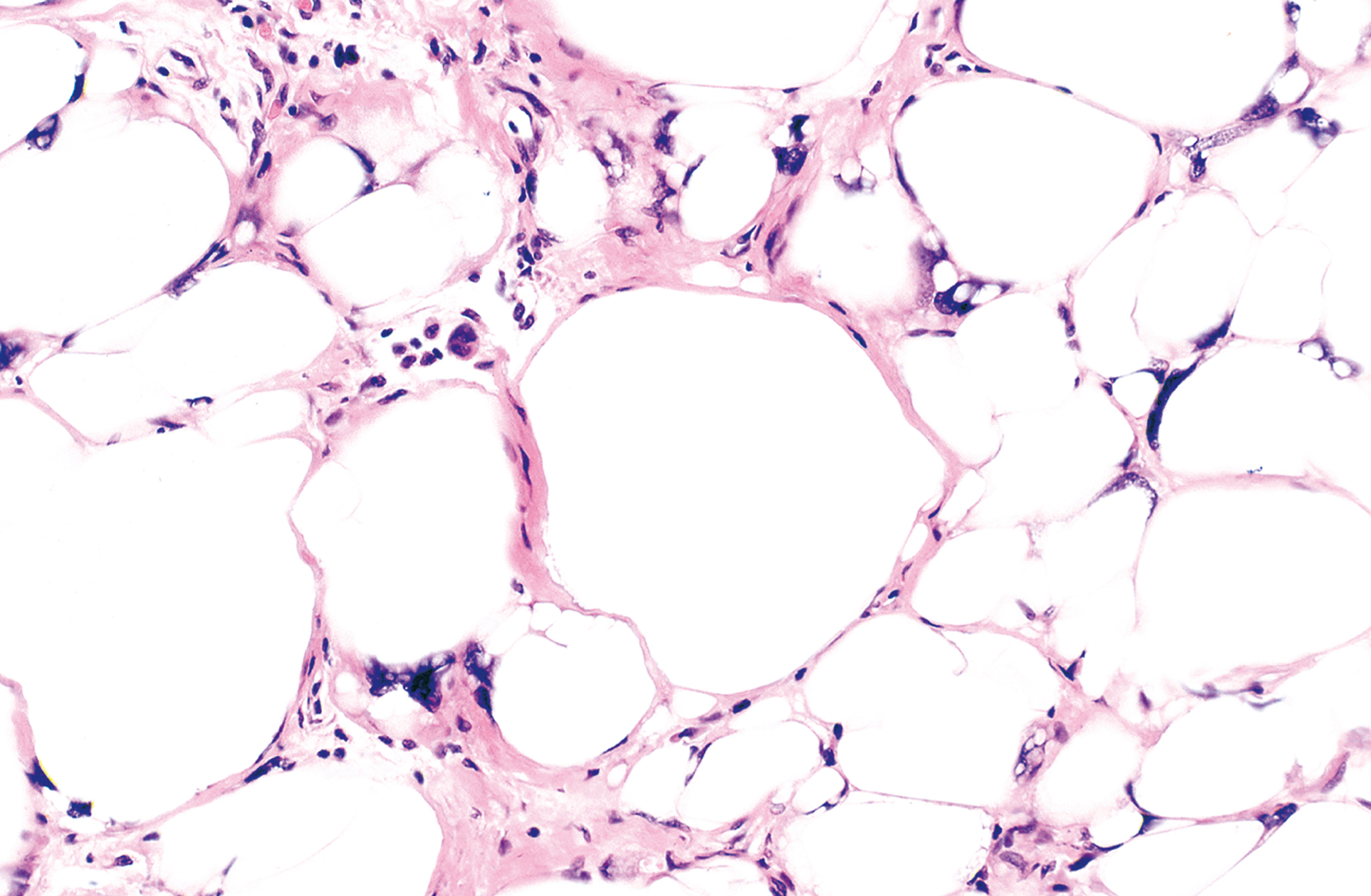 A microscopic views exhibits round cells with dark nuclei and fibrous structures under a microscope, and a large central cell surrounded by smaller ones.