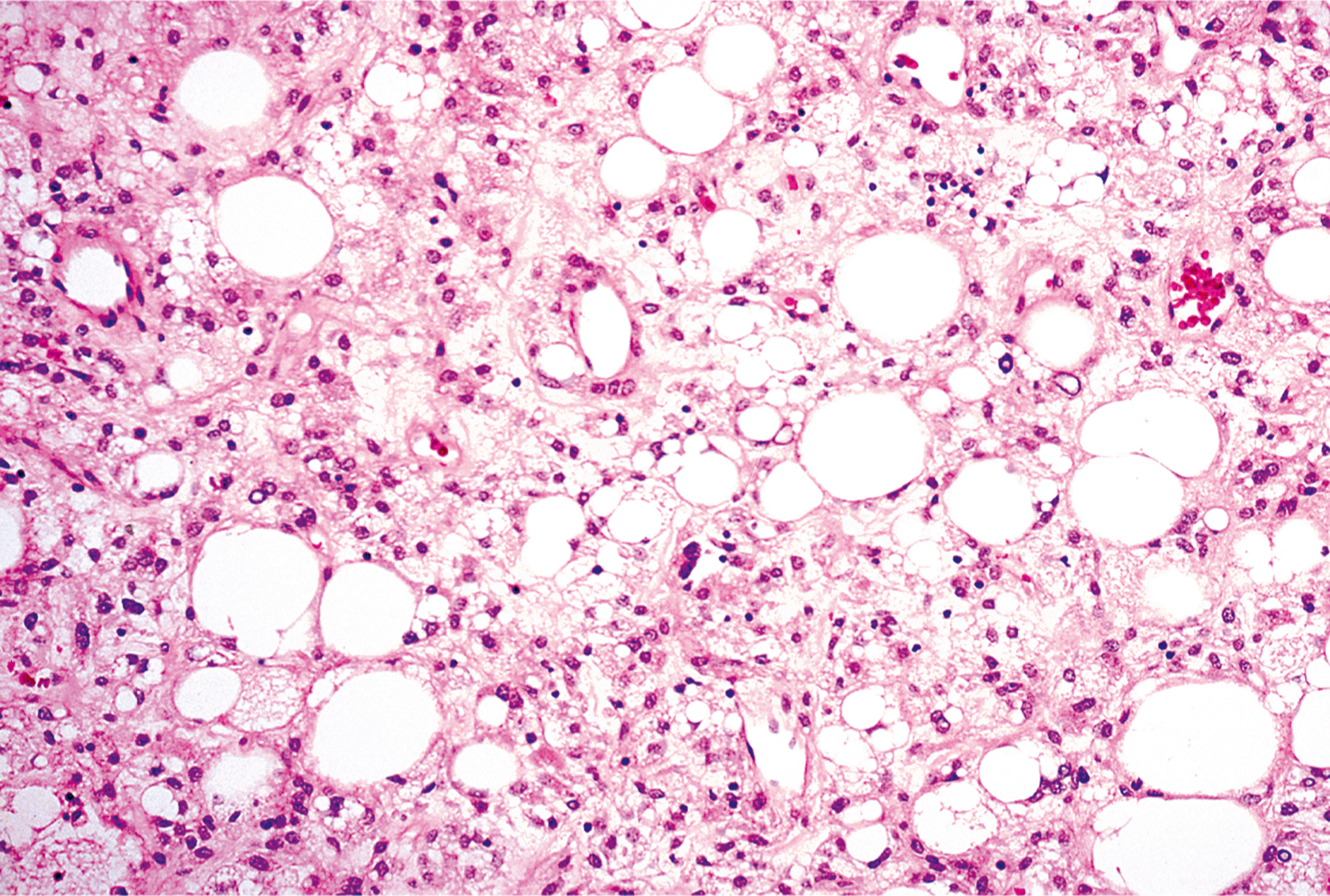 A microscopic views exhibits numerous round cells with dark nuclei and fibrous structures under a microscope, with varying cell sizes and scattered patterns.