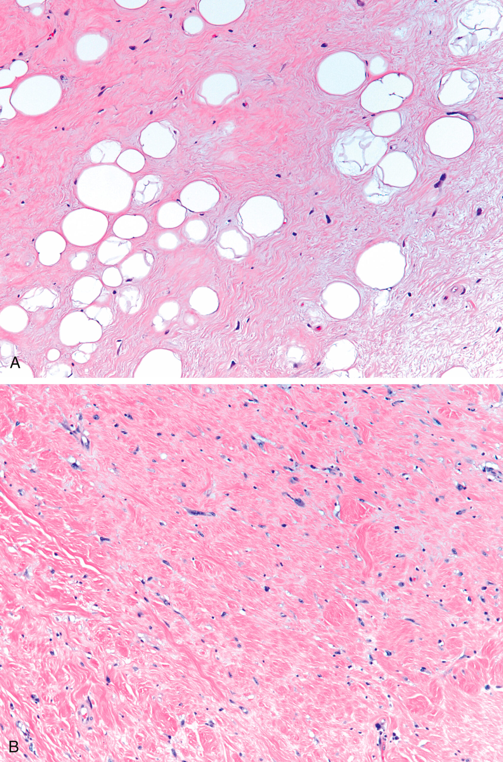 A histological slide showing adipocyte-rich and fibrous tissue with spindle cells in a myxoid matrix across three hematoxylin and eosin-stained panels. The histological slide presents three hematoxylin and eosin-stained panels. The upper left panel shows a transition from mature adipocytes to fibrous tissue with scattered spindle cells. The lower left panel reveals intersecting collagenous bundles with low cellularity and a pink-staining matrix. The right panel highlights a moderately cellular area with spindle-shaped tumor cells dispersed in a myxoid stroma, showing curvilinear vascular patterns and scattered inflammatory cells, suggestive of a myxoid soft tissue neoplasm.