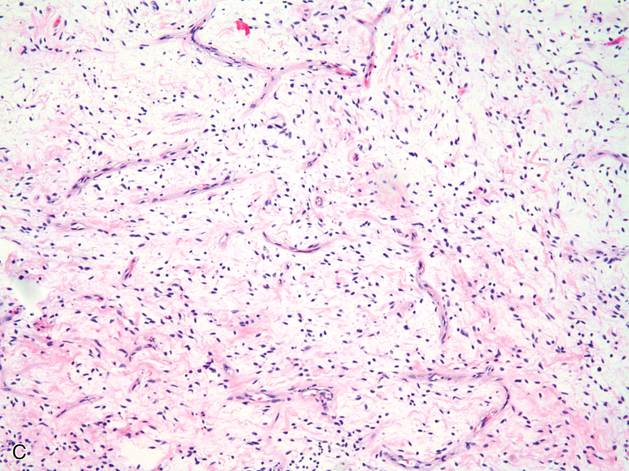 A histological slide showing adipocyte-rich and fibrous tissue with spindle cells in a myxoid matrix across three hematoxylin and eosin-stained panels. The histological slide presents three hematoxylin and eosin-stained panels. The upper left panel shows a transition from mature adipocytes to fibrous tissue with scattered spindle cells. The lower left panel reveals intersecting collagenous bundles with low cellularity and a pink-staining matrix. The right panel highlights a moderately cellular area with spindle-shaped tumor cells dispersed in a myxoid stroma, showing curvilinear vascular patterns and scattered inflammatory cells, suggestive of a myxoid soft tissue neoplasm.