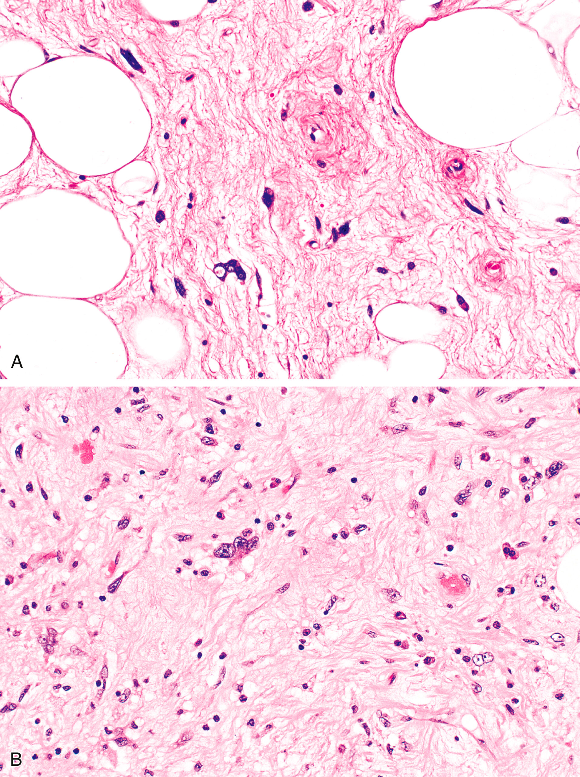 A panel of two microscopic views of a tissue sample exhibits fat round vacuoles with fibrous tissue in Part A. Part B is the magnified view that reveals the fibrous bands structures.