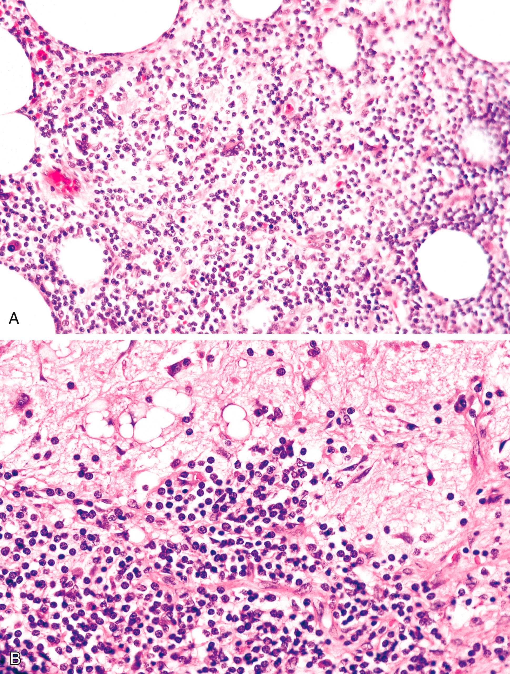 A panel of two microscopic views presents critical areas and histological patterns in the tissue section. The microscopic views are labeled Part A and Part B. Part A features the tissue sample with numerous circular structures dispersed throughout and a dense cell population that fills the spaces between the structures. The circular forms vary in size and appear randomly placed within the sample. Part B presents a magnified view with a fibrous network stretching across the area, connecting multiple circular structures of varying sizes. Scattered cells also appear within Part B, distributed unevenly among the fibrous strands and circular forms. No arrows or additional labels indicate specific focus areas in either part.