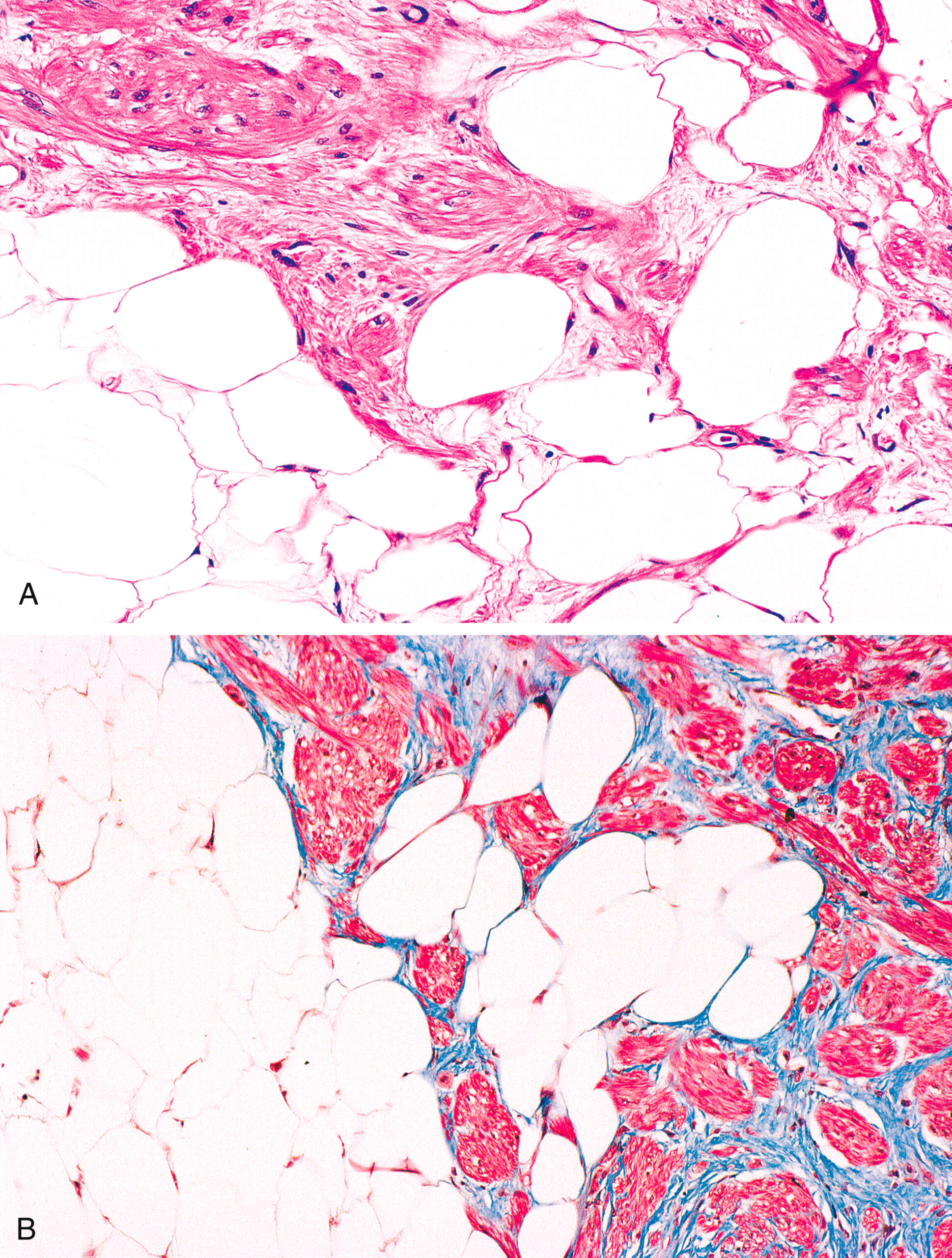 Two histological sections reveal specific morphological characteristics of a tissue section in general and magnified view. The histological sections are labeled Part A and Part B. Part A features a tissue sample with several large circular structures distributed across the area, connected by thin fibrous strands that form an open network. The circular structures vary in size and appear evenly spaced within the sample. Part B presents the magnified view with multiple circular structures of similar size embedded within a denser fibrous network. The fibrous strands in Part B appear thicker and more closely packed, filling the spaces between the circular forms and creating a more compact composition