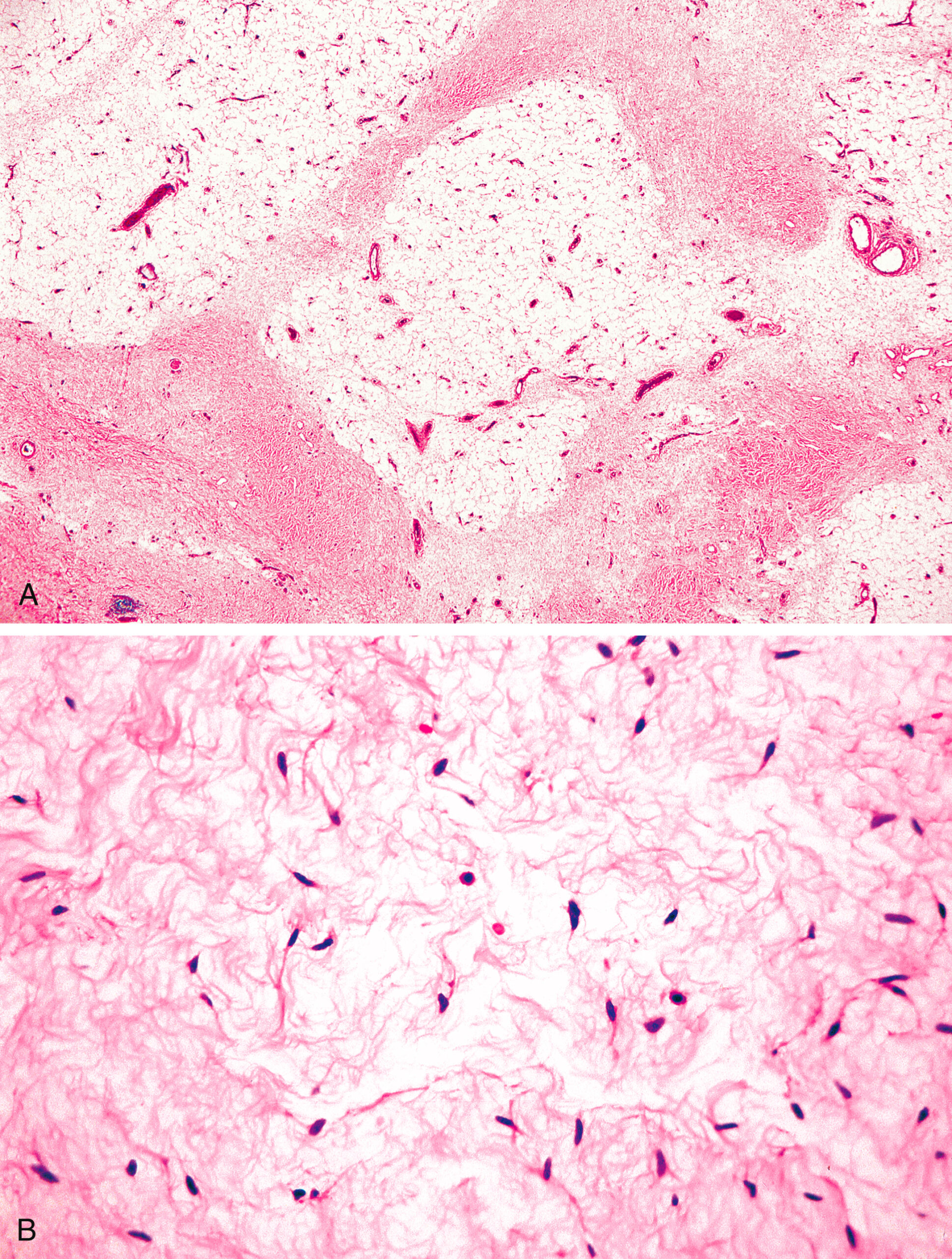 A panel of two microscopic views displays a tissue sample with fibrous strands and circular structures in Part A. Part B includes a dense network of fibrous strands with scattered cells.