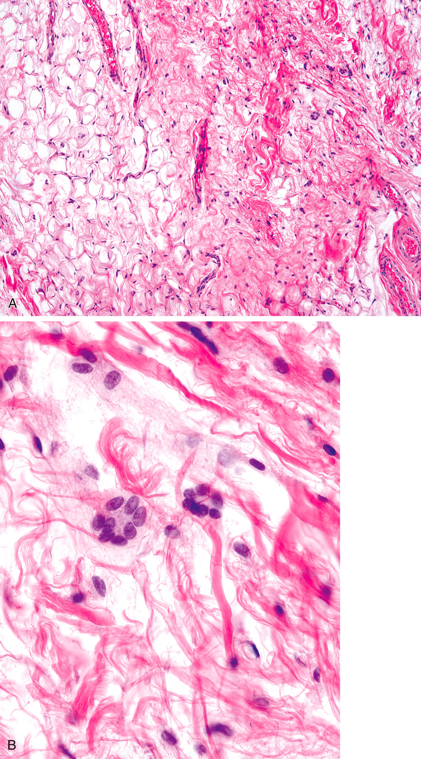 A panel of two microscopic views displays a tissue sample with a honeycomb pattern and fibrous strands in Part A. Part B includes a tissue sample with a fibrous network and clustered cells.