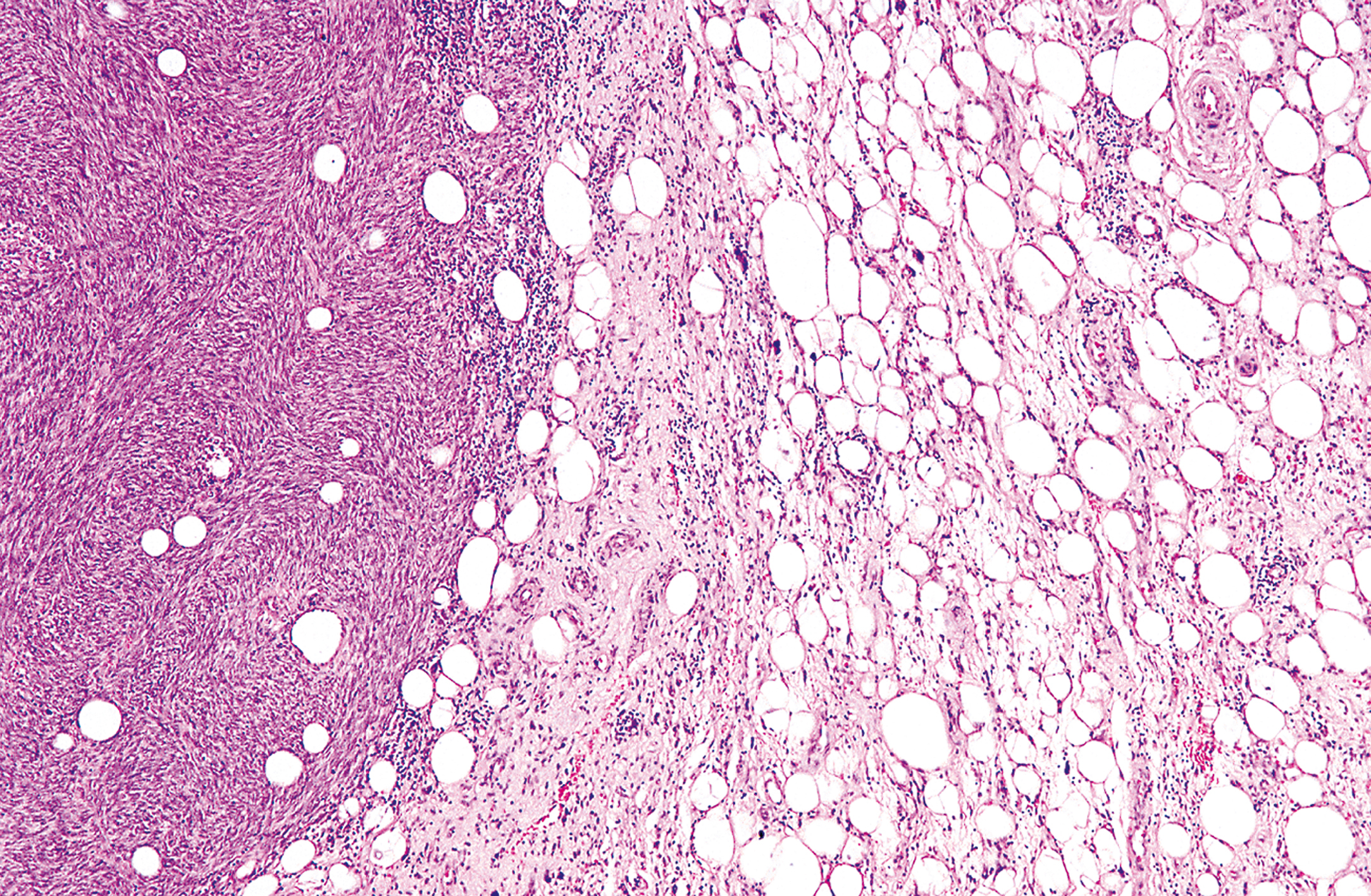A microscopic view presents a tissue sample with a dense cellular area on the left and multiple circular structures on the right, separated by fibrous strands.