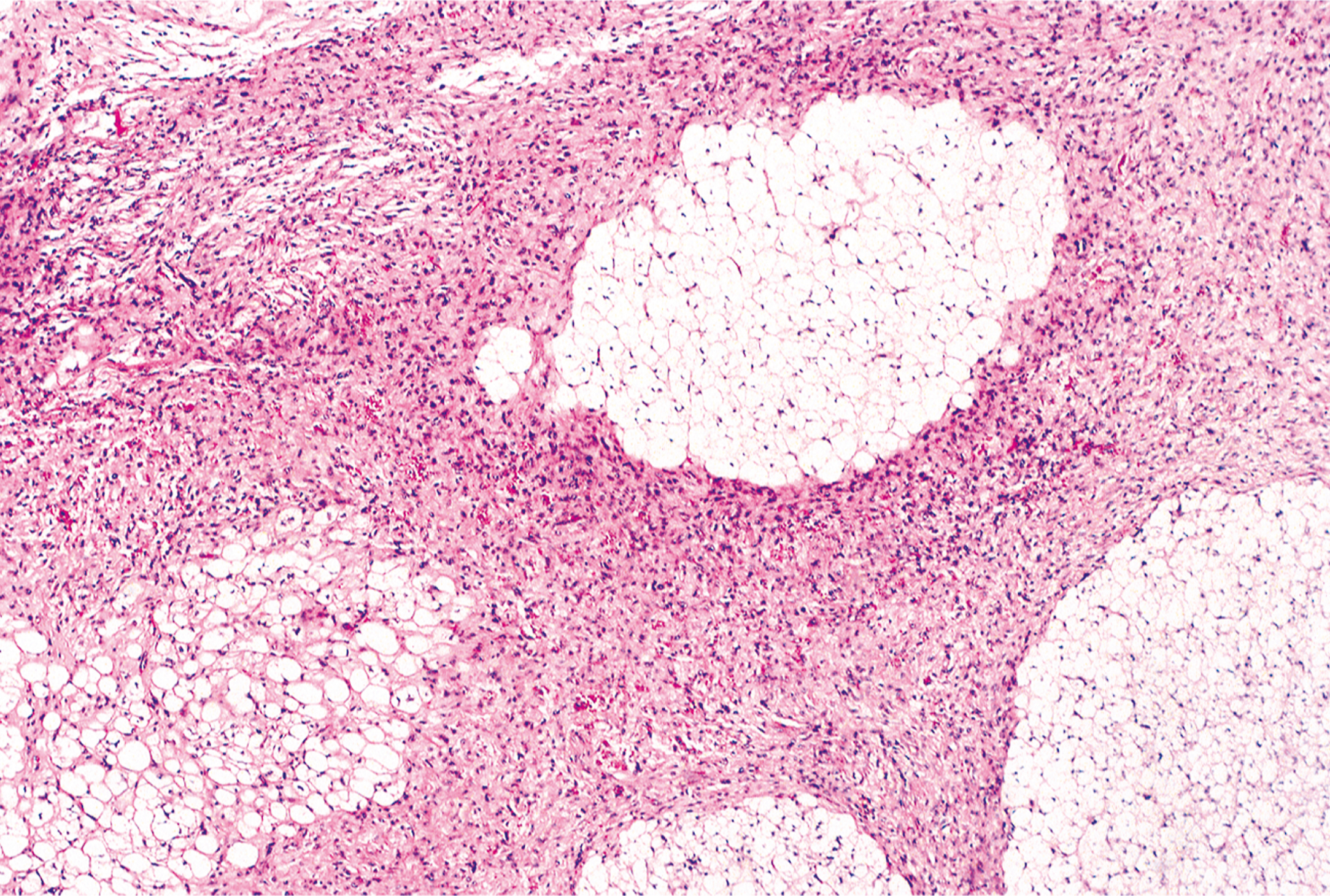 A microscopic view presents a tissue sample with a dense cellular region on the left and multiple large circular structures on the right, connected by fibrous strands.