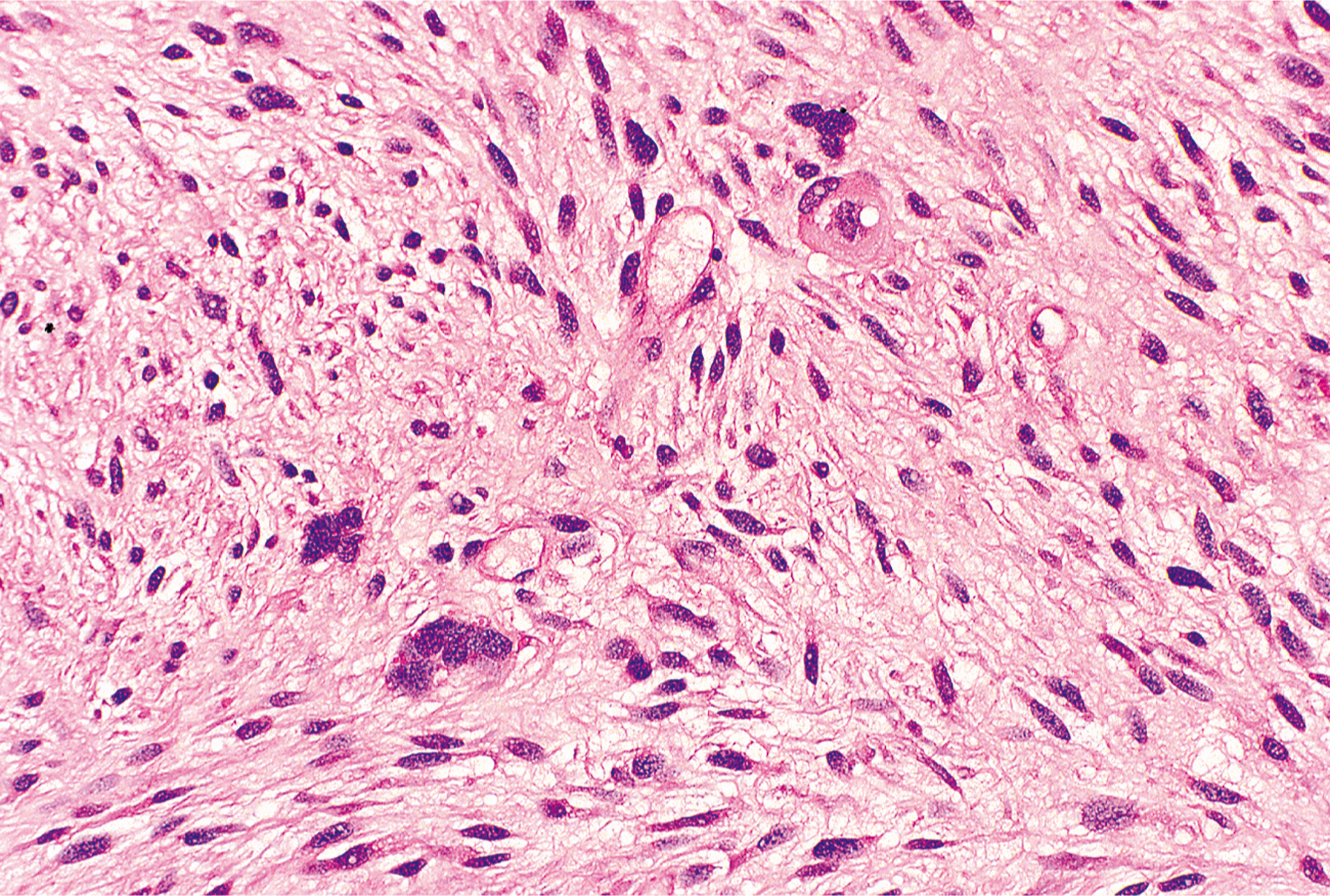 A microscopic views exhibits elongated cells with dark nuclei and fibrous structures under a microscope, with a dense and irregular pattern.