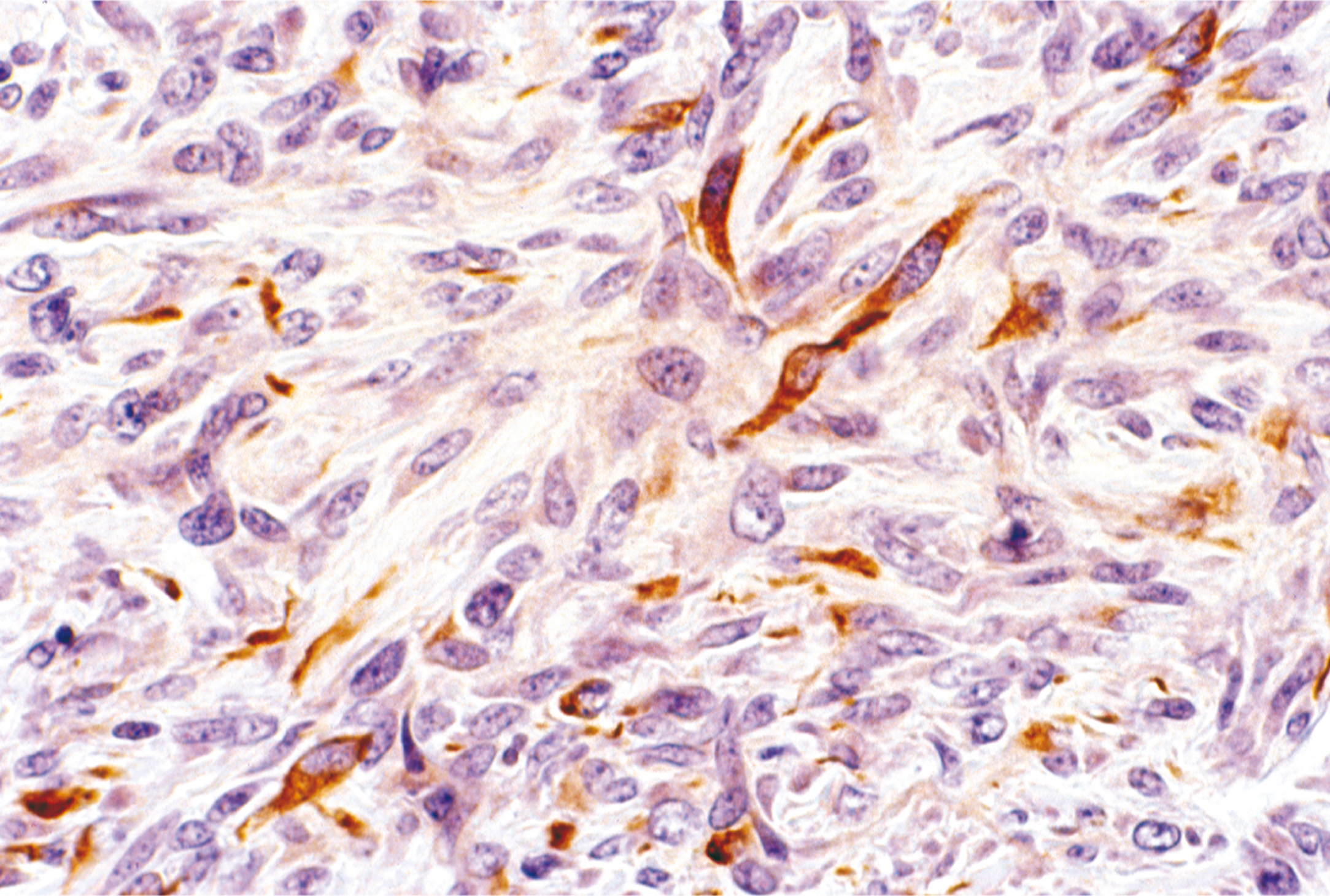 A microscopic view exhibits a fibrous structure with prominent fat regions and well-differentiated zones with the presence of brown stains.