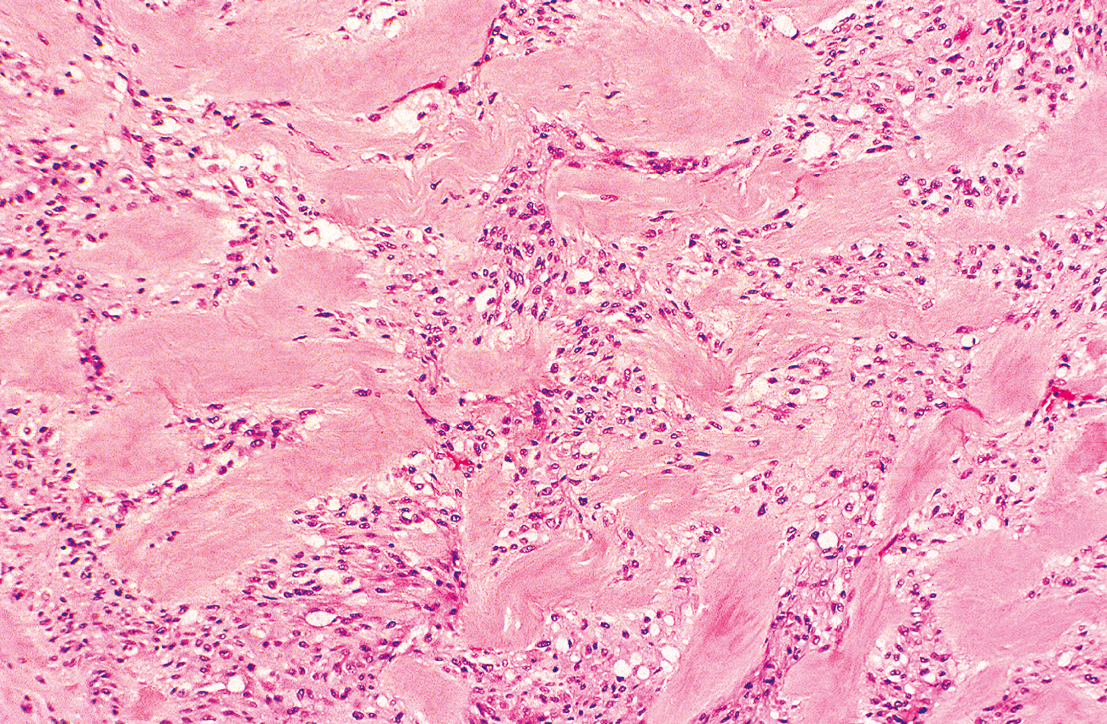 A microscopic views exhibits elongated cells with dark nuclei and fibrous structures under a microscope, with a dense and wavy pattern.