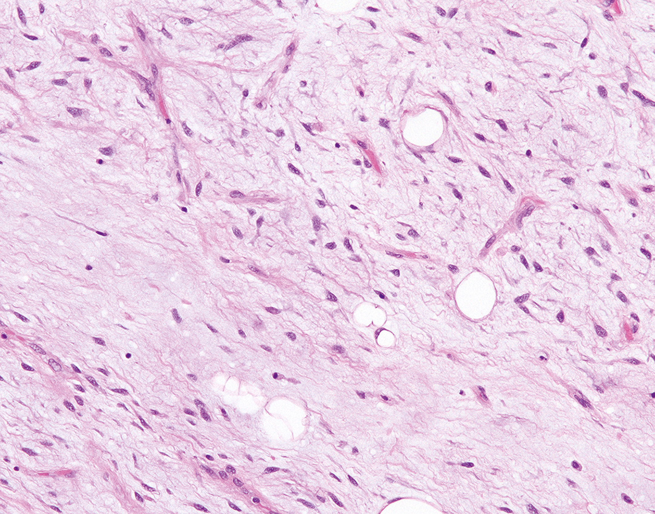 A microscopic views exhibits elongated cells with dark nuclei and fibrous structures under a microscope, with scattered round cells present.